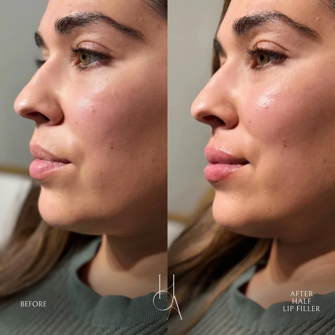 Adding balance and symmetry to her side profile ✨
Just the right touch with our Subtle Lip Filler treatment to softly enhance her natural shape, creating harmony between her top and bottom lip while keeping everything beautifully natural and aligned 