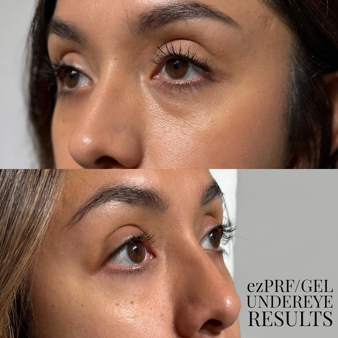Results after a series of three ezPRF/Gel undereye treatments 🤍 Naturally brightened and rejuvenated using your own plasma &mdash; no filler needed!  #UnderEyeRejuvenation #EZPRFGel