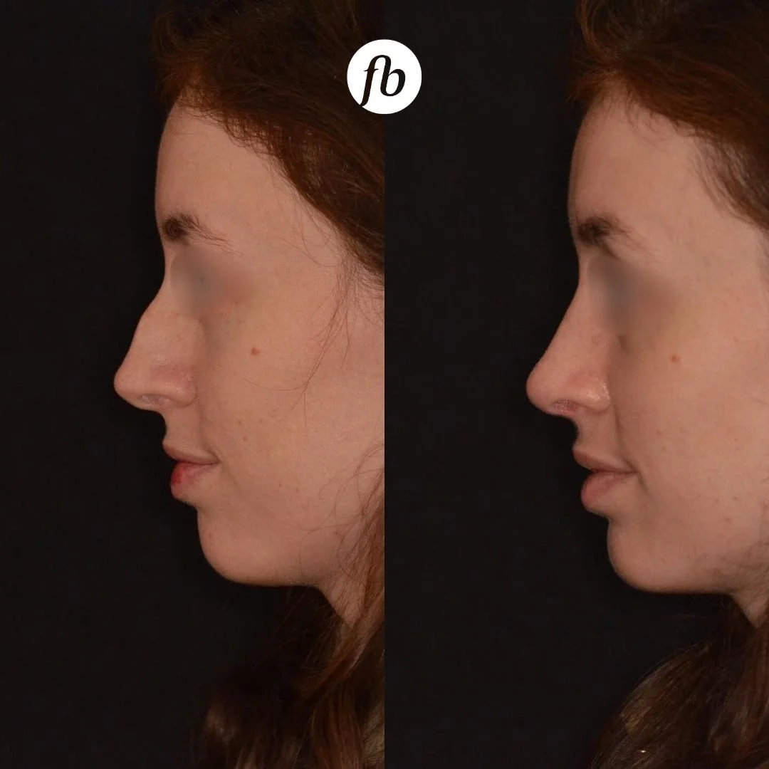 Side-by-side comparison of a woman's profile before and after a cosmetic procedure, showing changes to her nose.