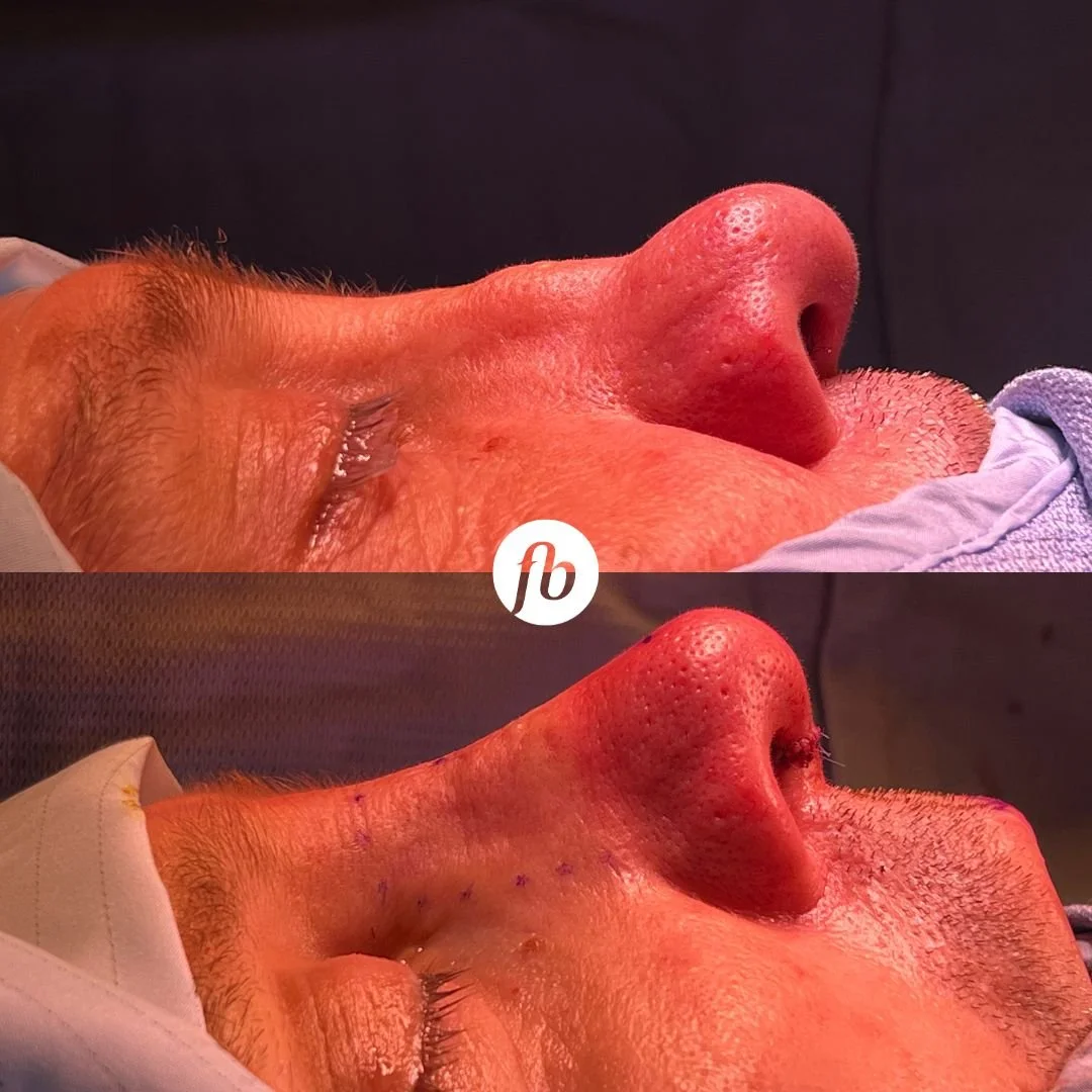 Close-up of a person's nose and face, showing a rhinoplasty before and after, with visible improvements in nasal structure. 