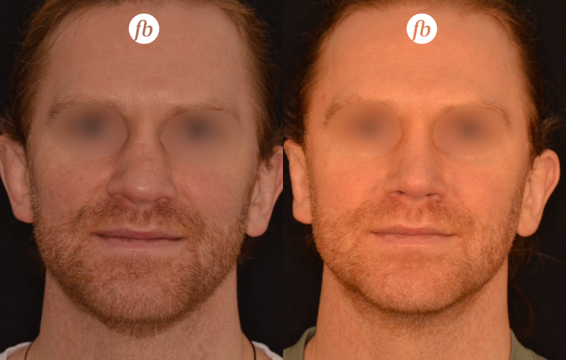 Rebuilding the Nose After Sports-Related Trauma: A Professional Rugby Player’s Rhinoplasty Case Study
