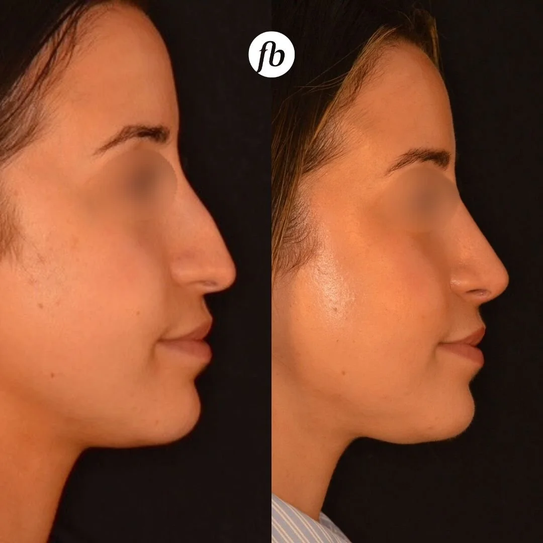 Side-by-side comparison of a woman's face before and after cosmetic rhinoplasty, showing a refined nose shape and improved profile.