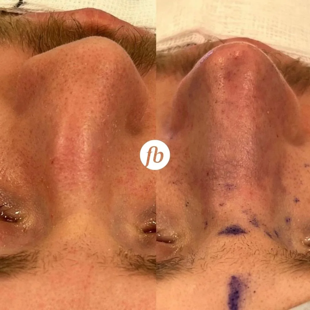 Close-up of a person's nose before and after a rhinoplasty procedure, showing changes in appearance.