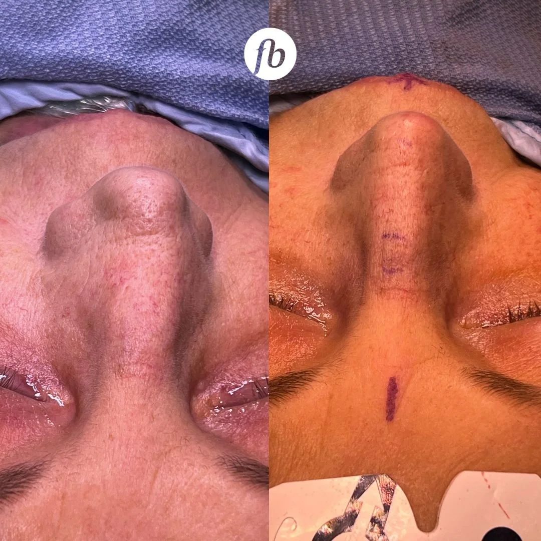 Side-by-side comparison of a person's nose before and after a rhinoplasty surgery, showing changes in shape and contour.