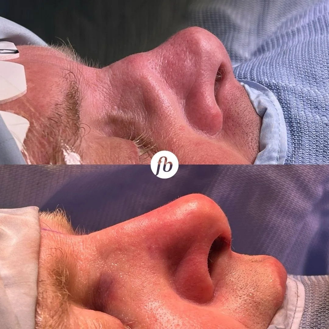 Comparison of a man's nose before and after a rhinoplasty procedure.