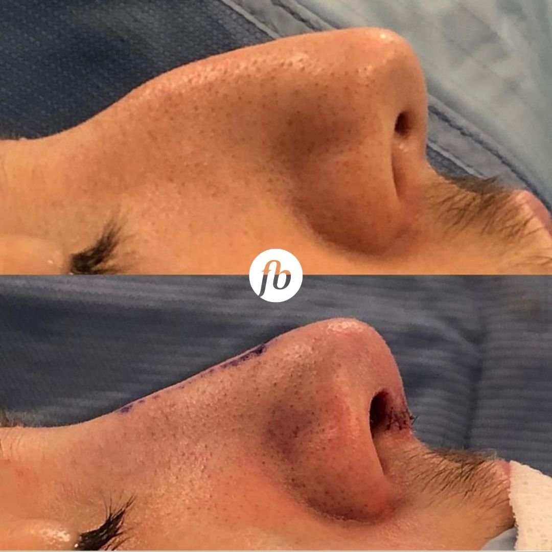 Close-up side view of a person's nose before and after a cosmetic procedure, showing straightening of the dorsal hump 