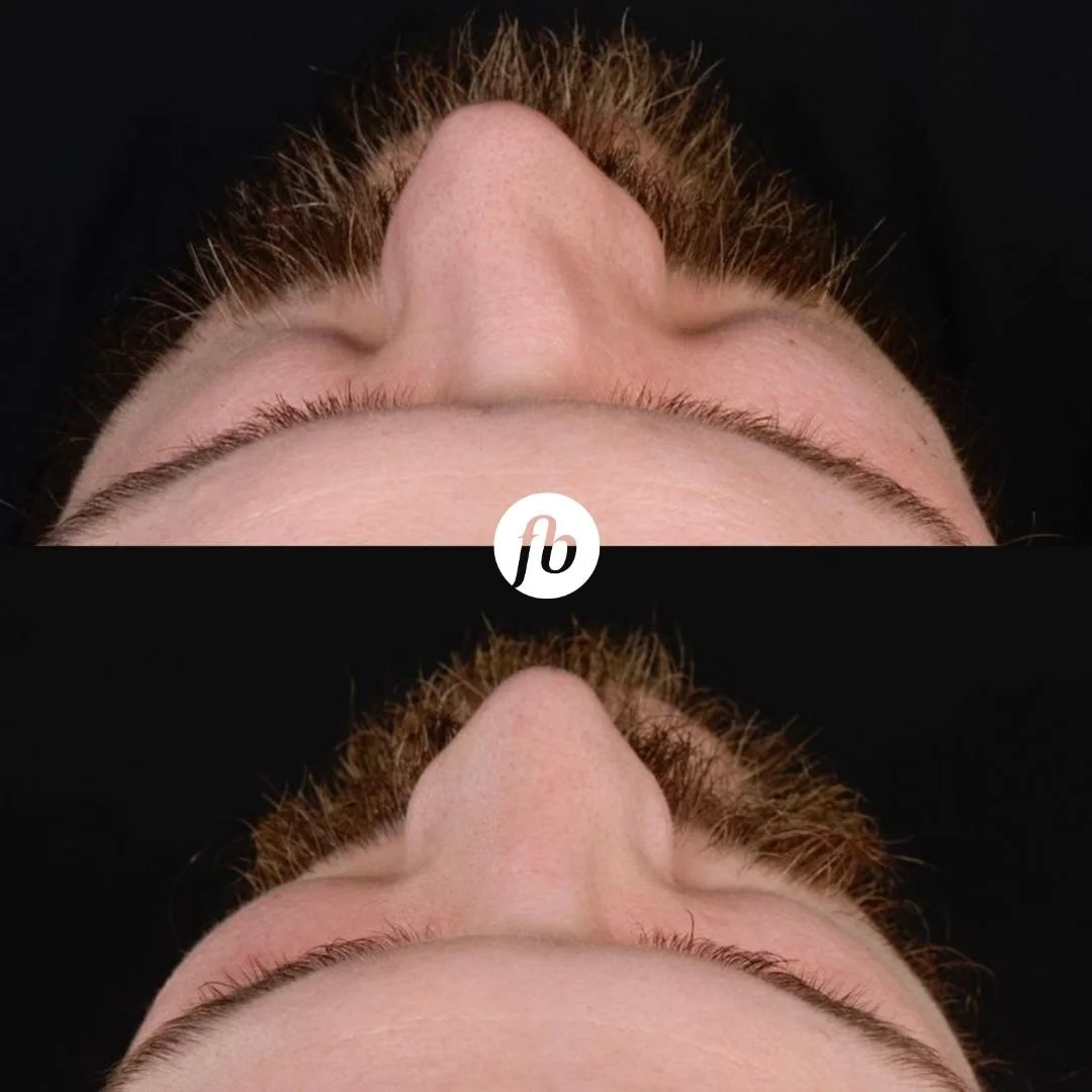 Close-up of a person's nose and forehead, showing before and after images of the straightening of the nose through rhinoplasty. 