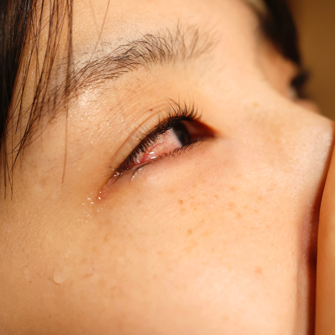 Close up of a womans eye red from an infection