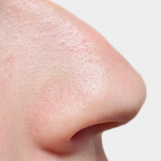 a nose with a hump or bump on it