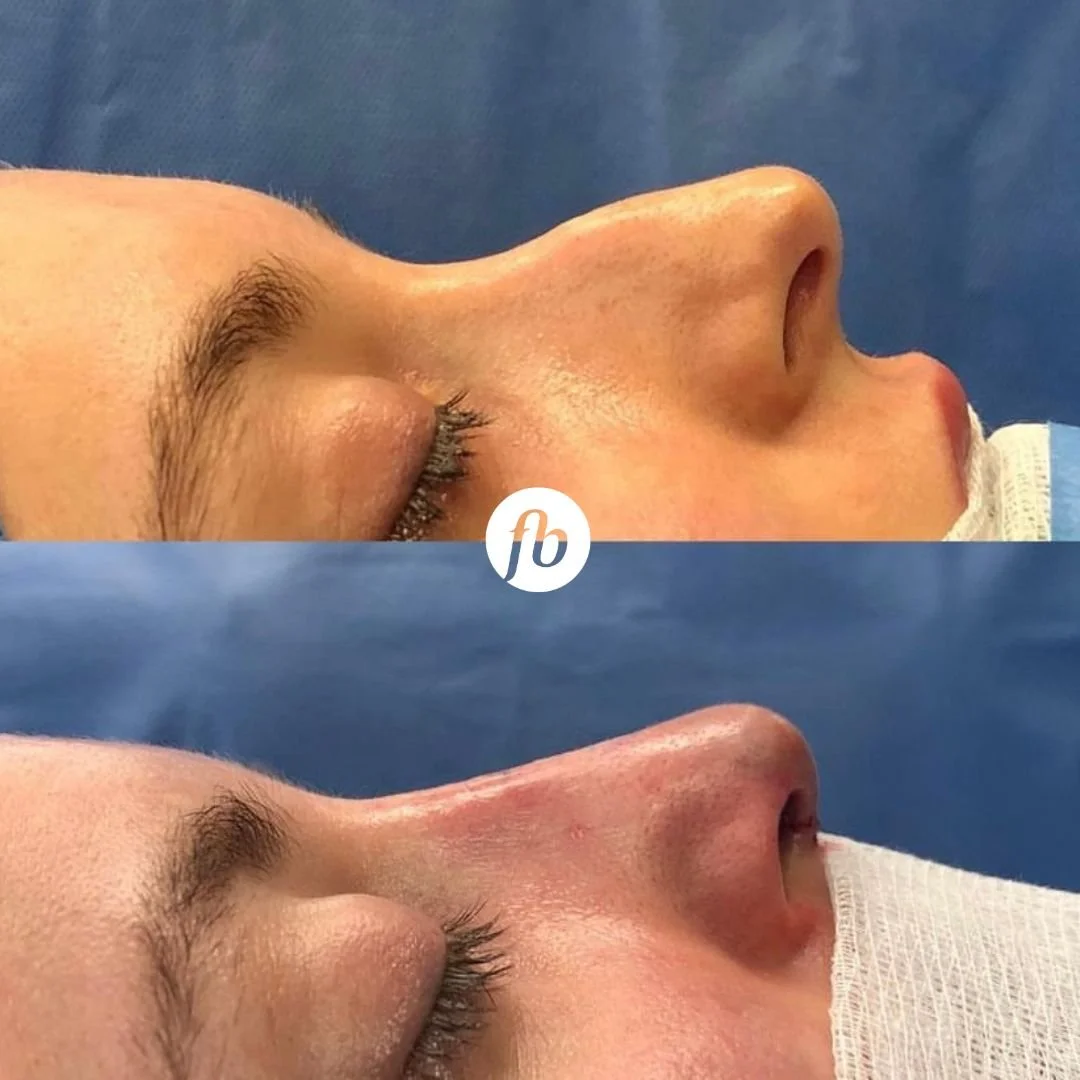 Side-by-side photos of a person's face showing before and after a rhinoplasty procedure, with a nasal bridge and nostrils visible.