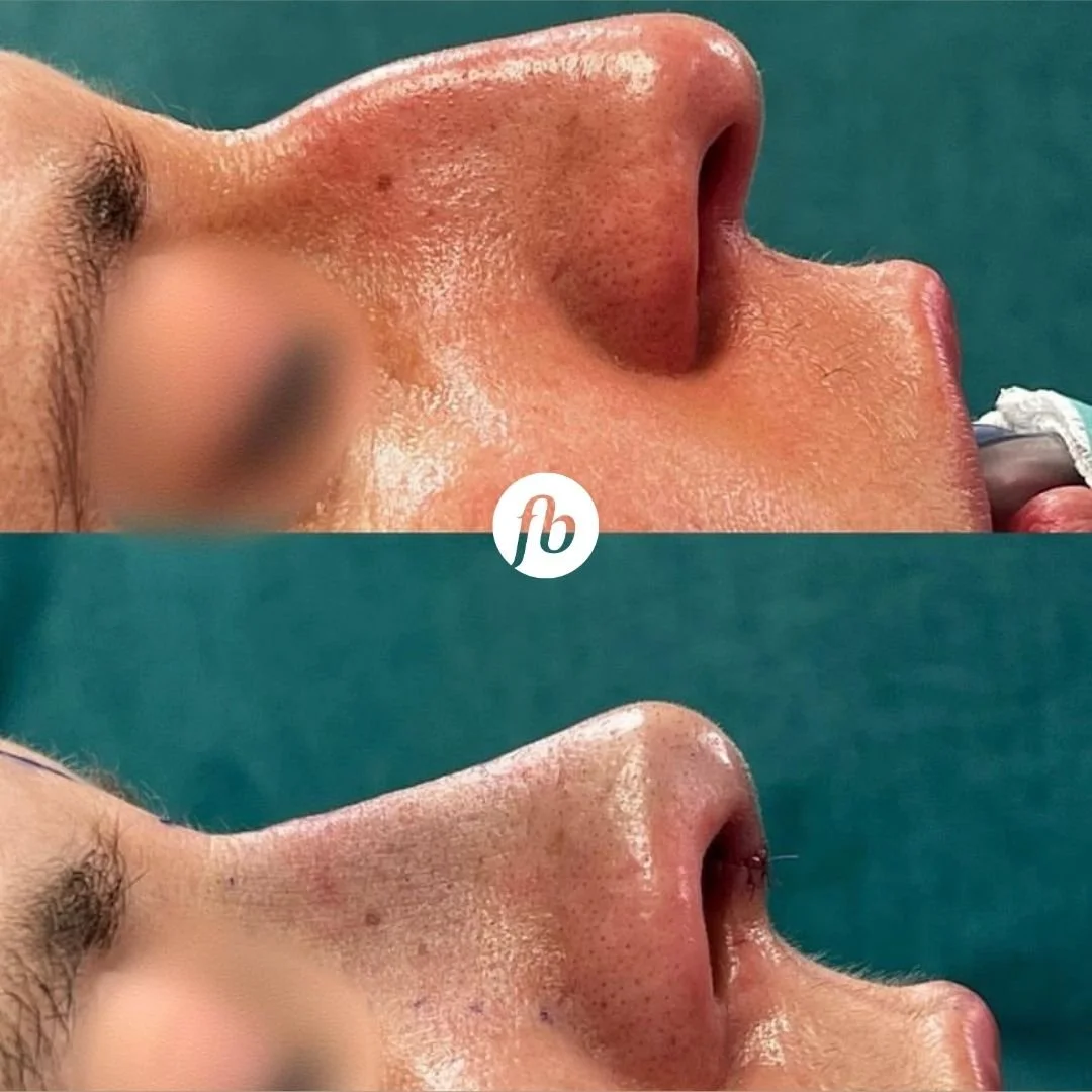 Close-up of a person's nose before and after a rhinoplasty procedure, showing a straighter nose and a more stable tip 