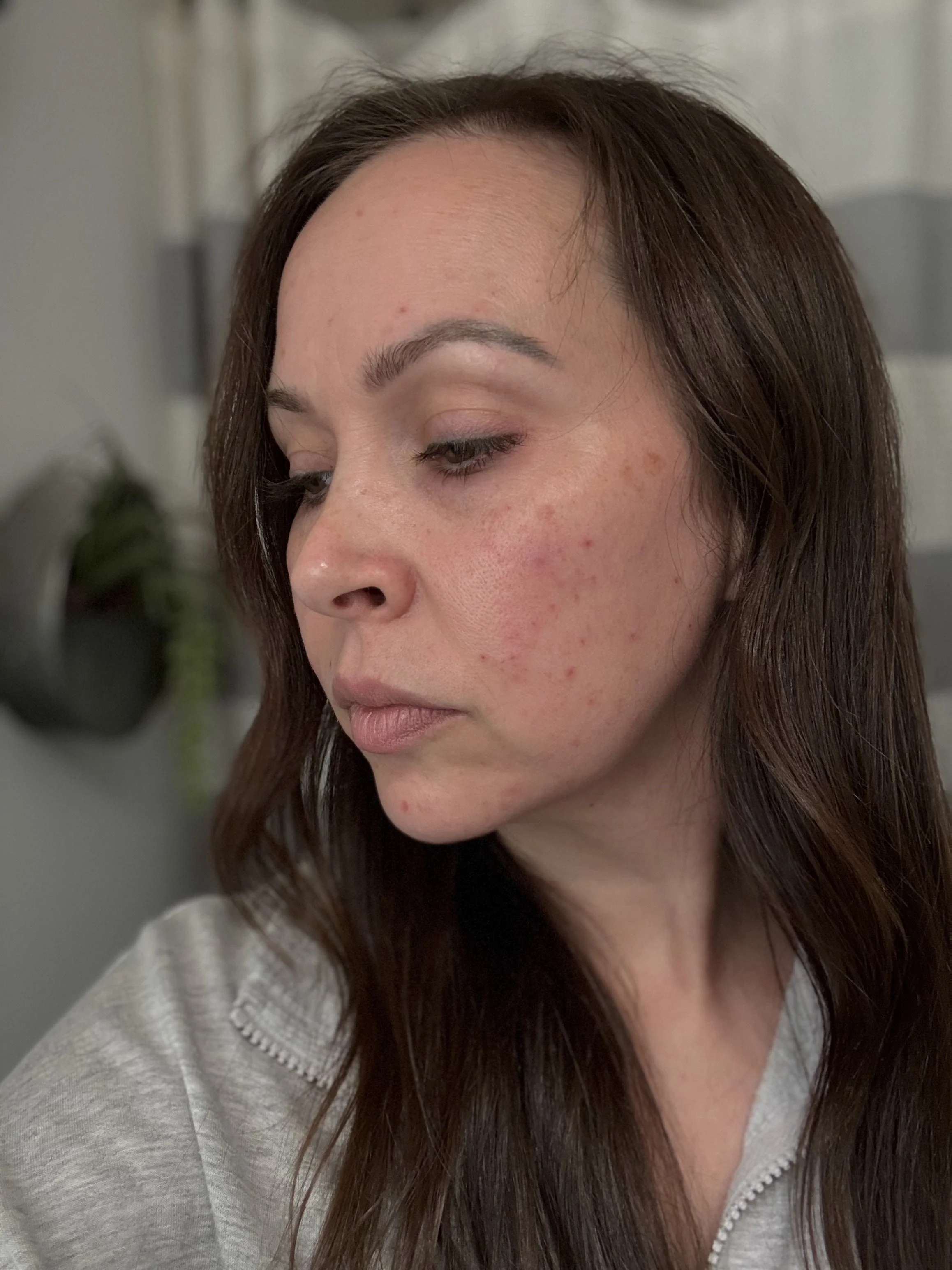 Hormonal Acne Sucks: Here's My 3-Day Skincare Reset That Actually Works