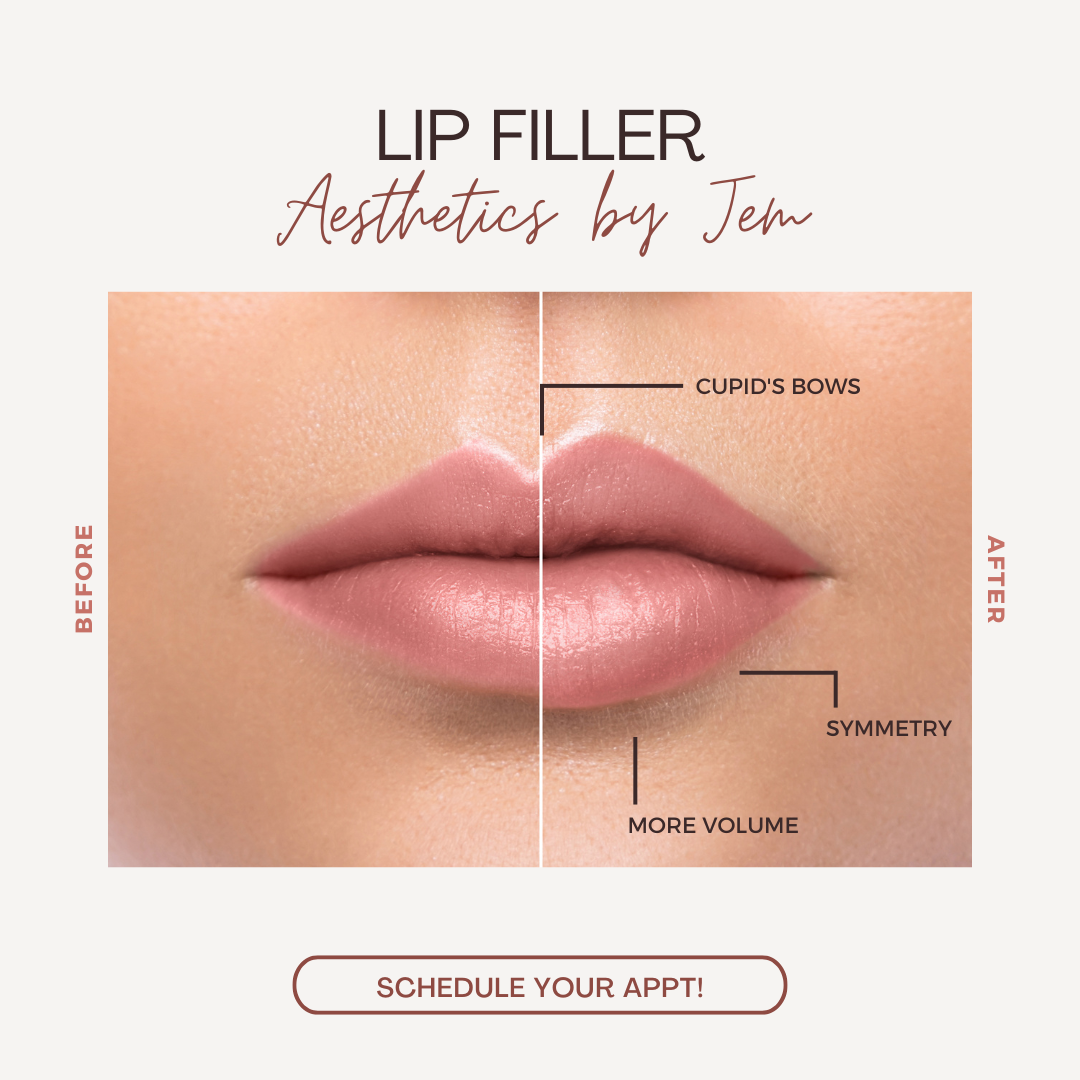 Lip Filler Post
