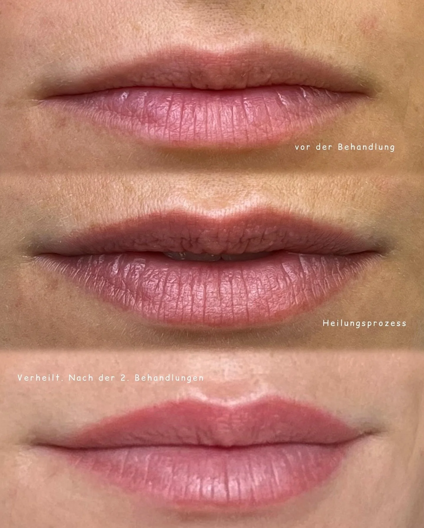 Lippenpigmentierung bei der lieben @jana.rexha 🤍

Ich hatte das Vergn&uuml;gen, Jana ein traumhaftes L&auml;cheln zu zaubern - mit einer sanften Lippenpigmentierung, die ihre nat&uuml;rliche Sch&ouml;nheit unterstreicht.

Die Farbe? Perfekt auf ihre