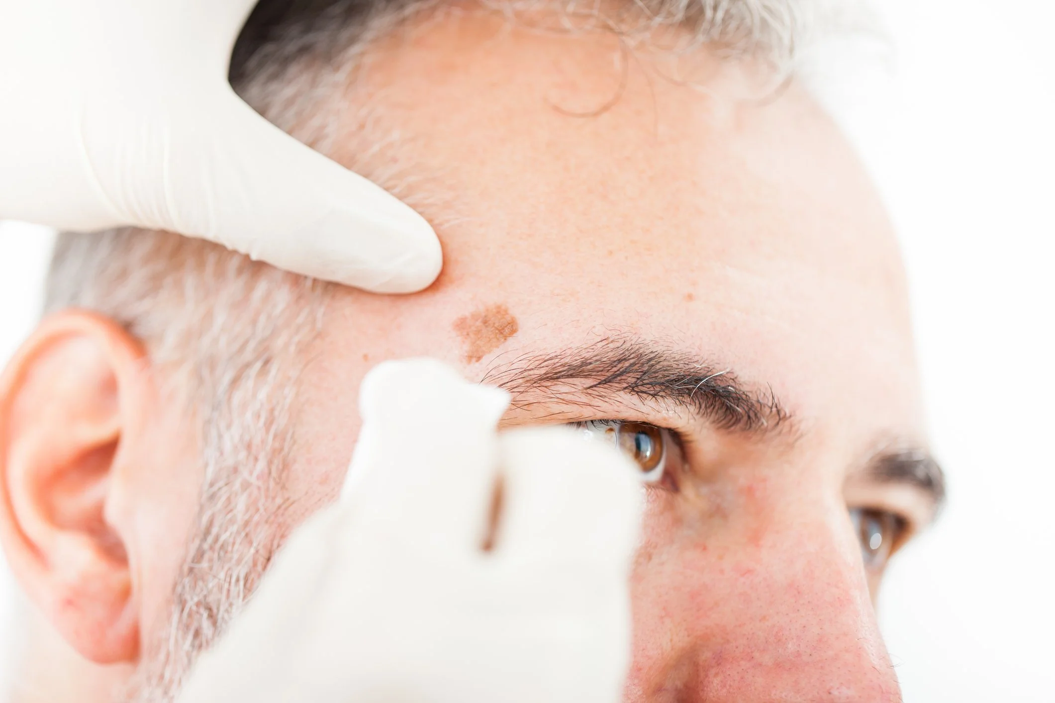 Keratosis Removal