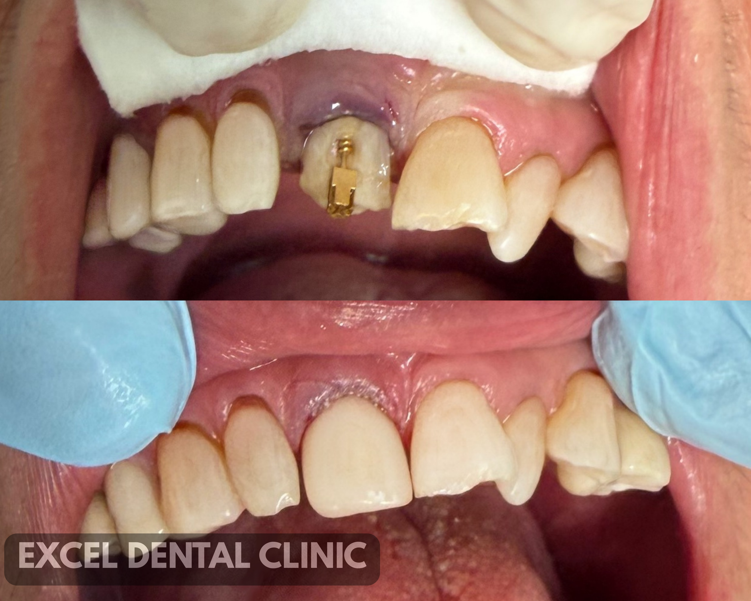 Before and after dental treatment showing a patient with missing front teeth, with the upper front teeth restored to a natural appearance.