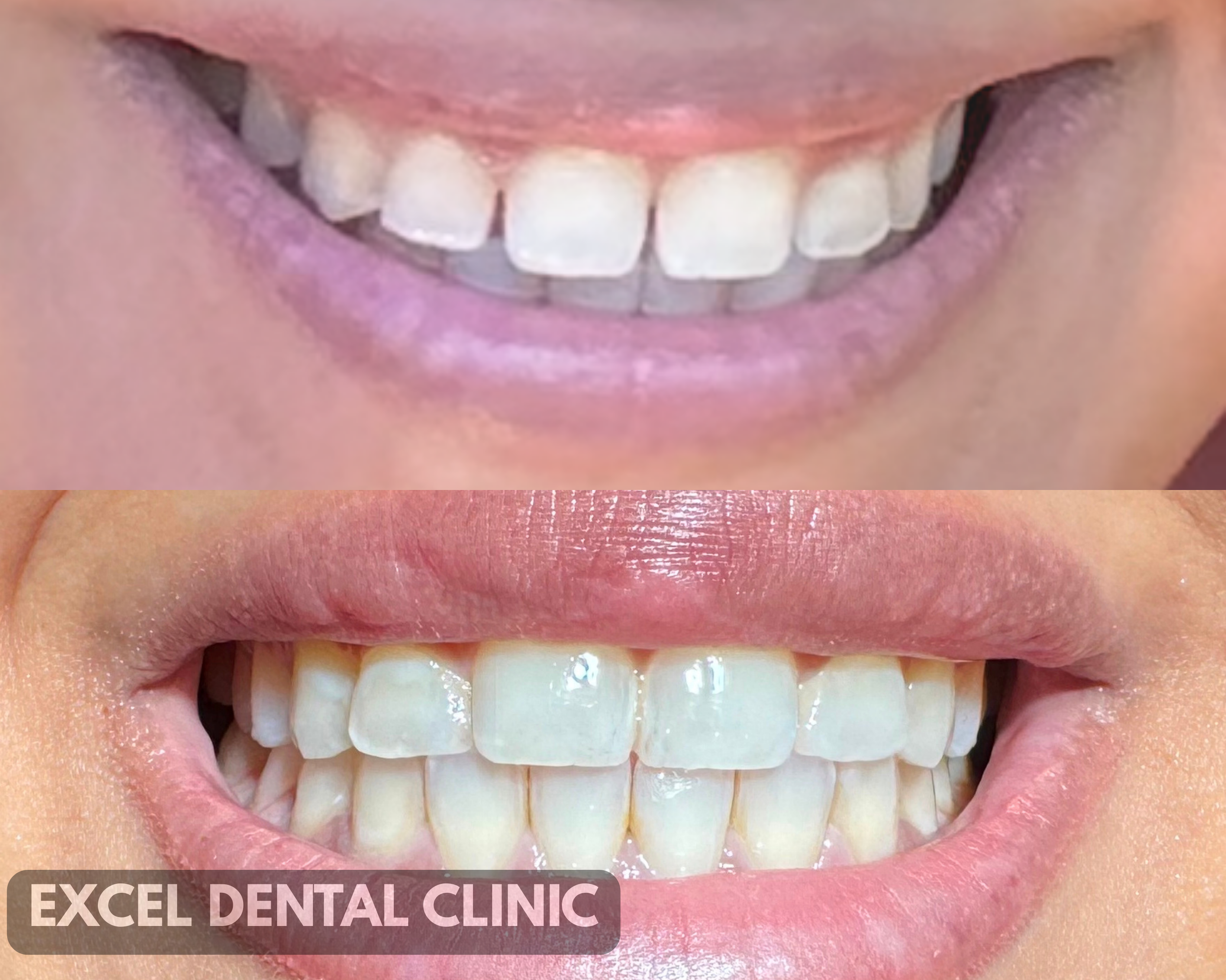 Comparison of two smiles, showing before and after dental treatment at Excel Dental Clinic.