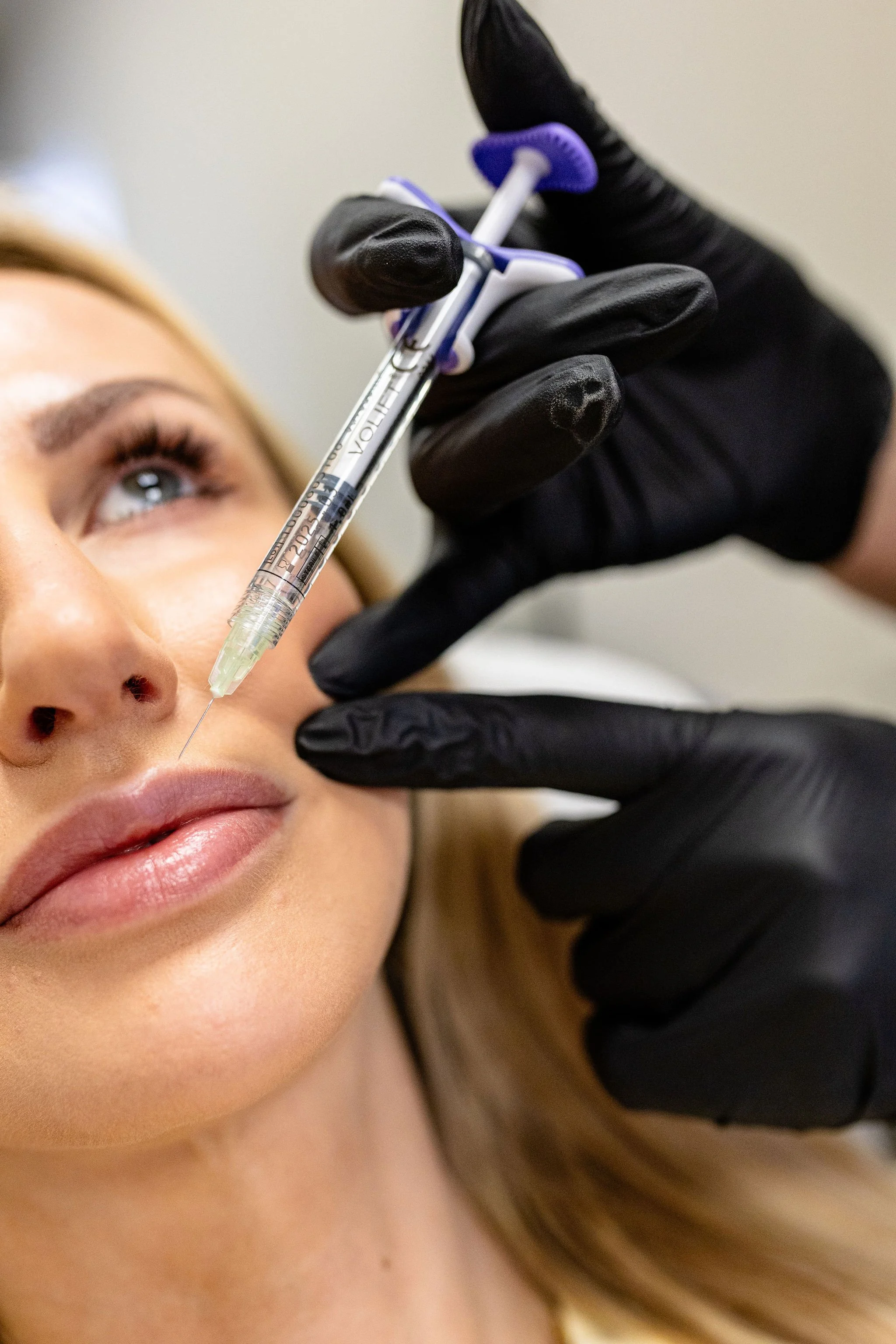 Dermal filler treatments