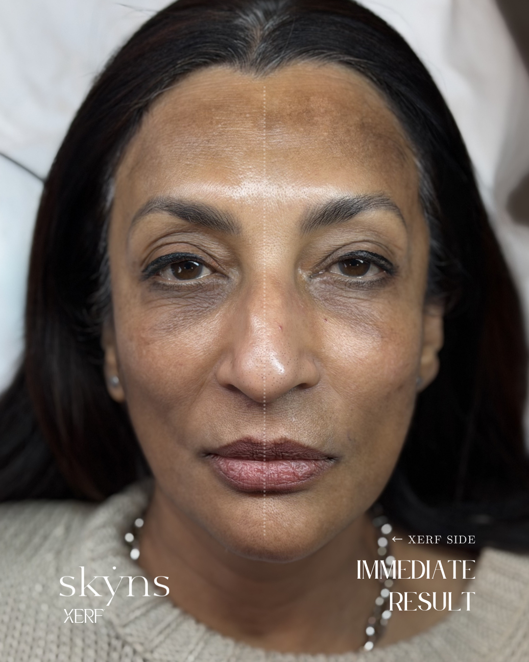 XERF structural skin tightening treatment demonstrating the treated side immediately after treatment.