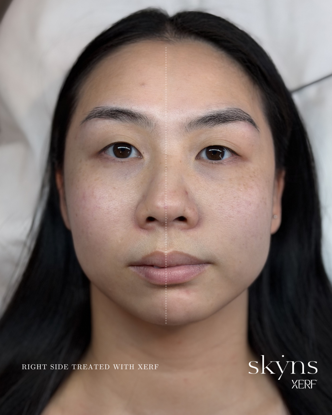 xerf-calgary-before-after-half-face-32.png