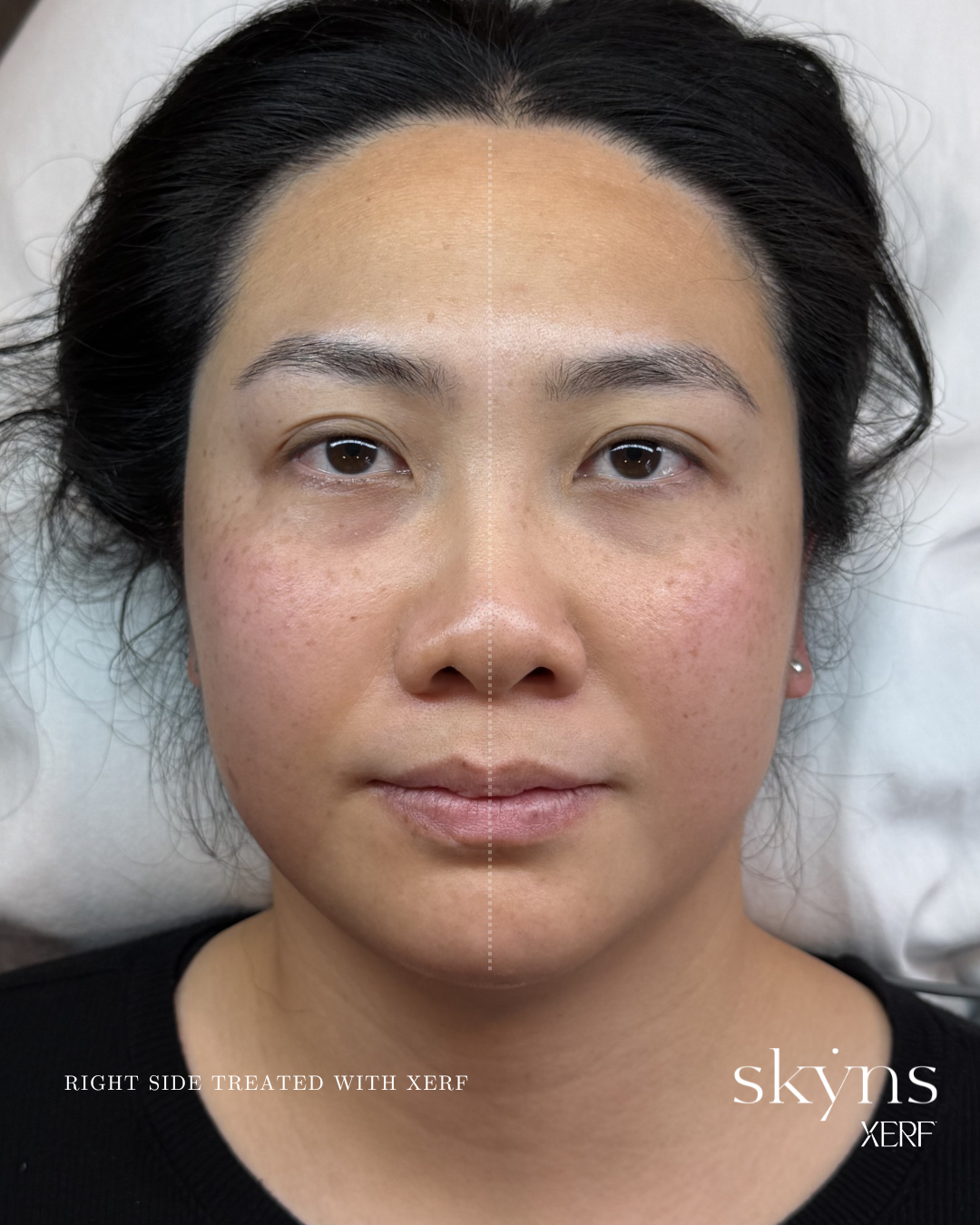 xerf-calgary-before-after-half-face-33.png