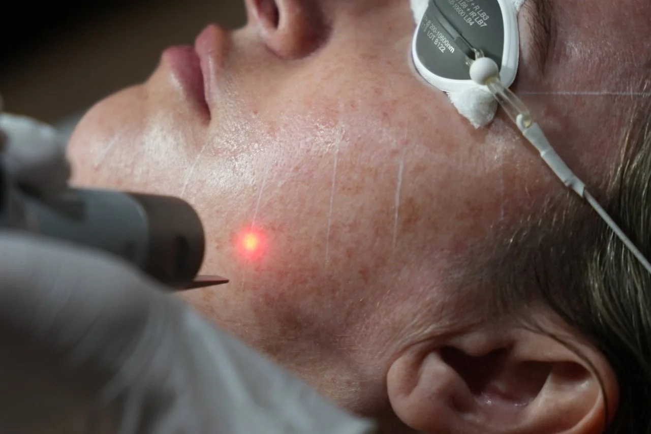 PicoSure Pro pigmentation treatment