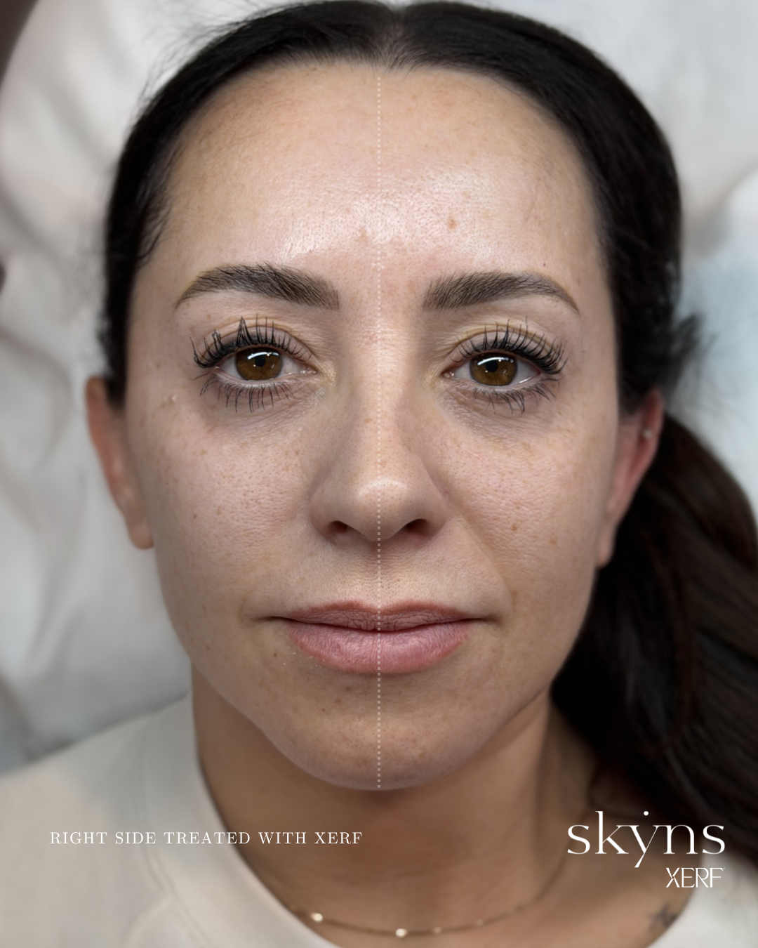xerf-calgary-before-after-half-face-5.png