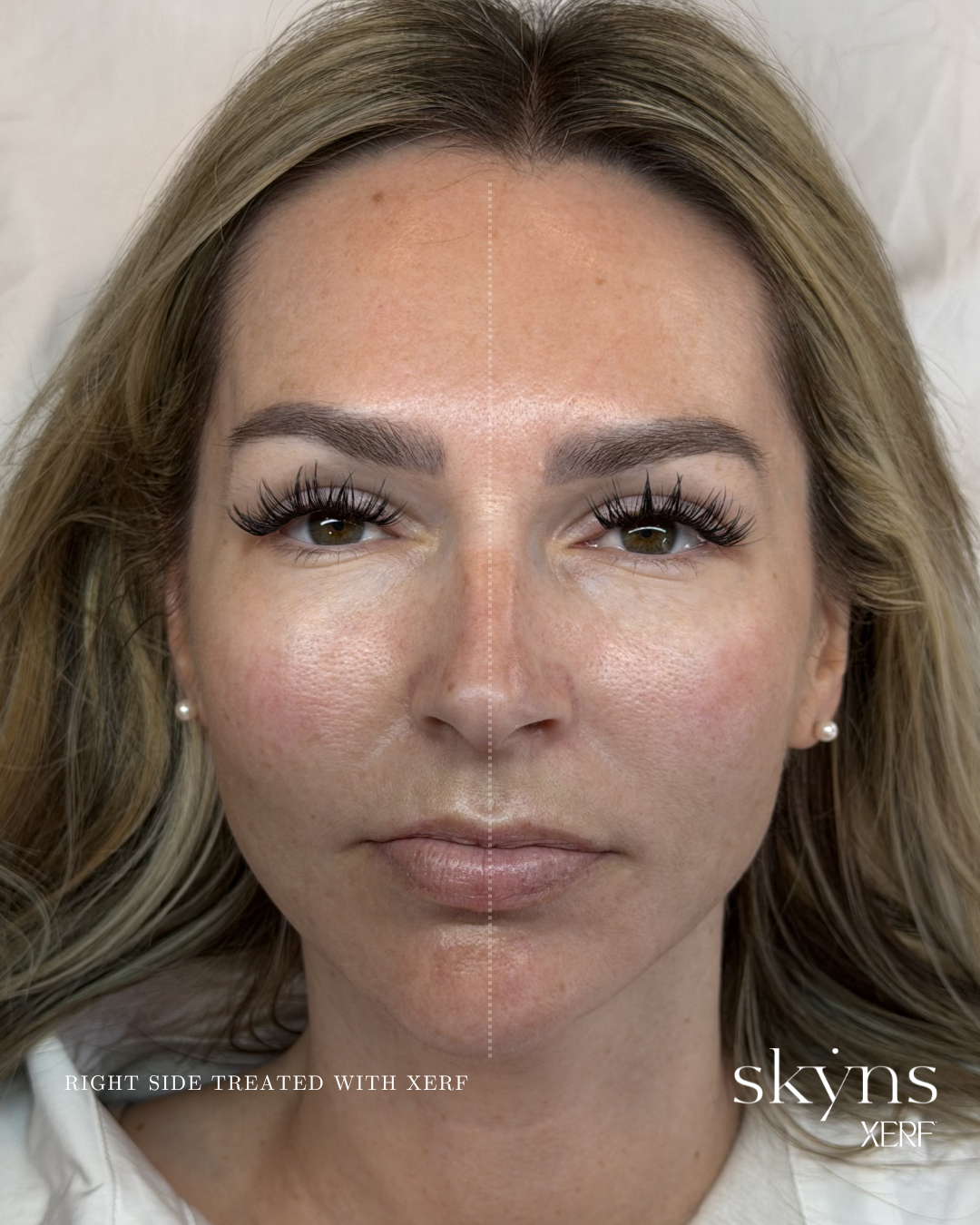 xerf-calgary-before-after-half-face-30.png