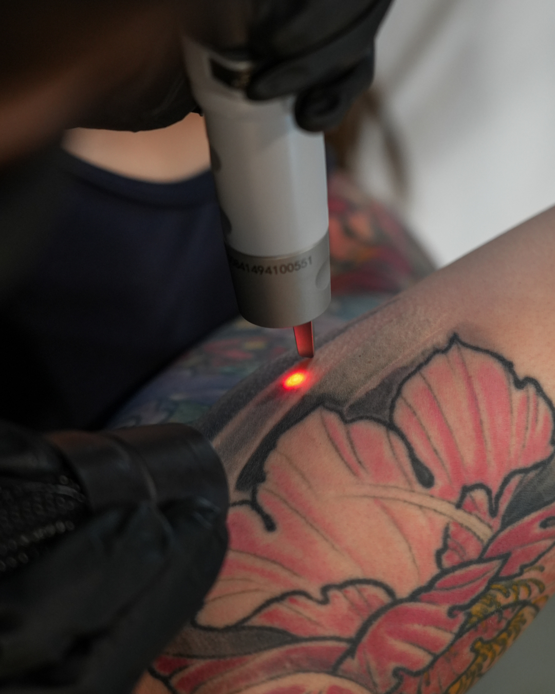 PicoSure Pro laser body tattoo removal treatment at SKYNS laser clinic in Calgary