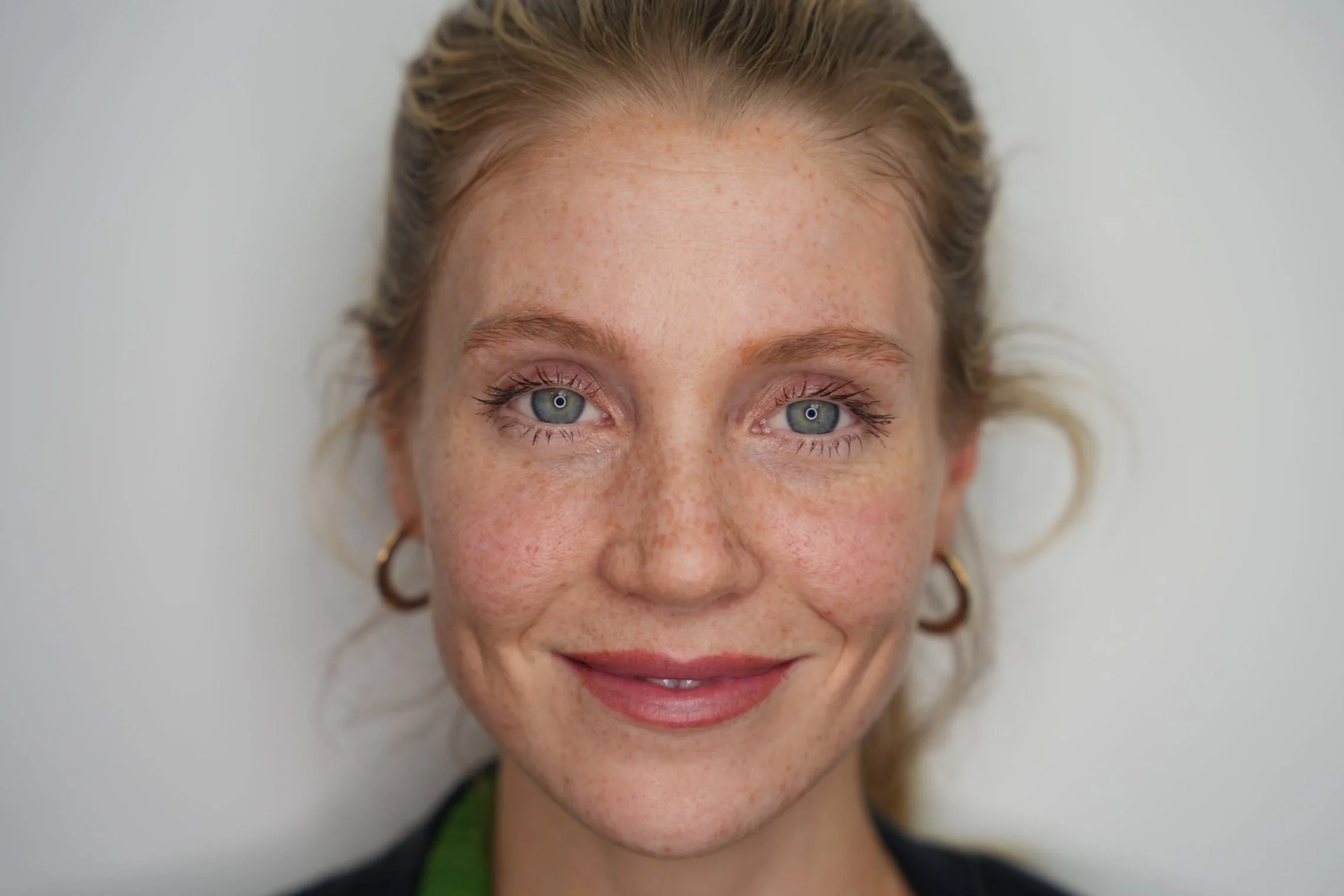 PicoSure Pro collagen stimulation treatment