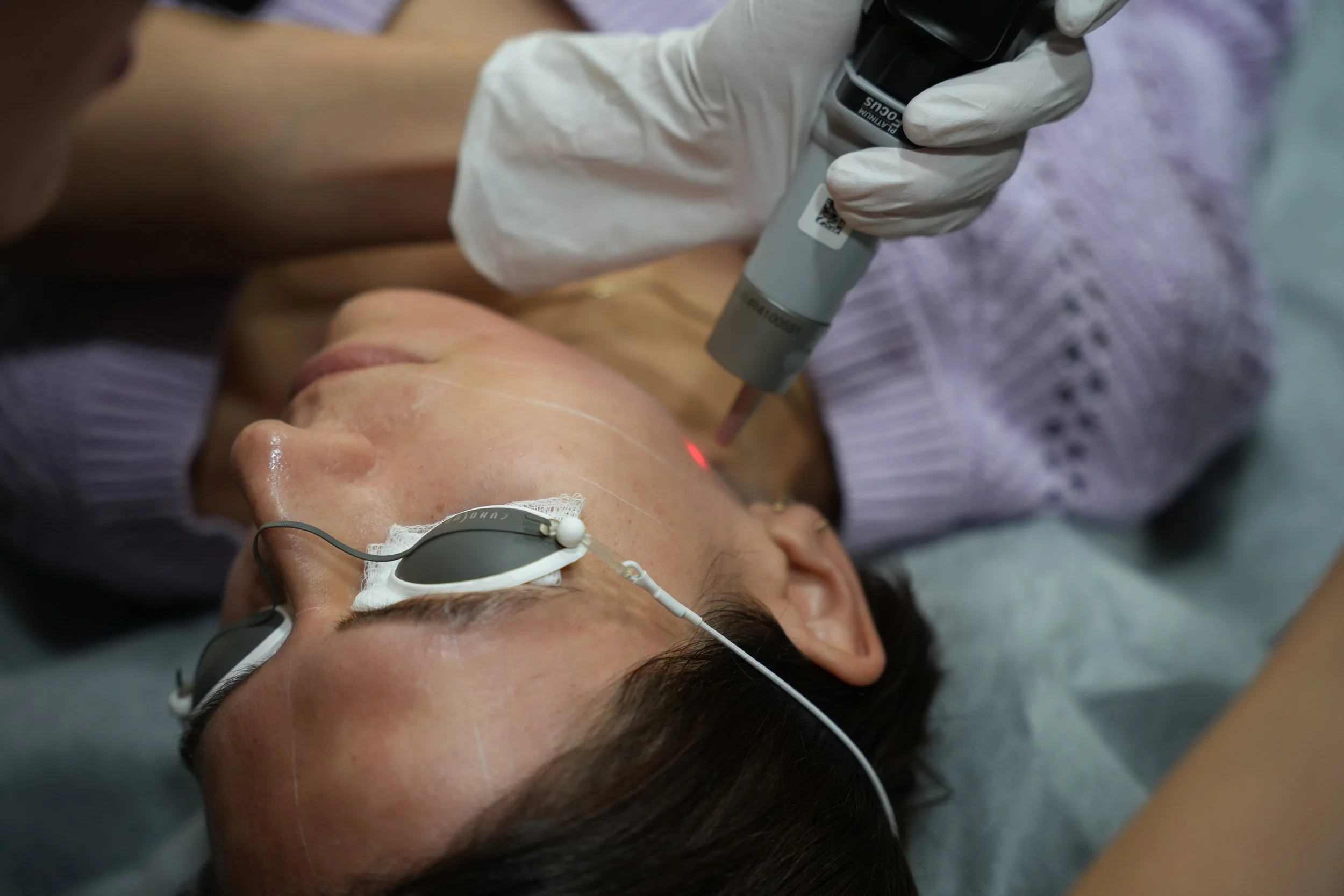 Client receiving a PicoSure Pro skin rejuvenation treatment 1