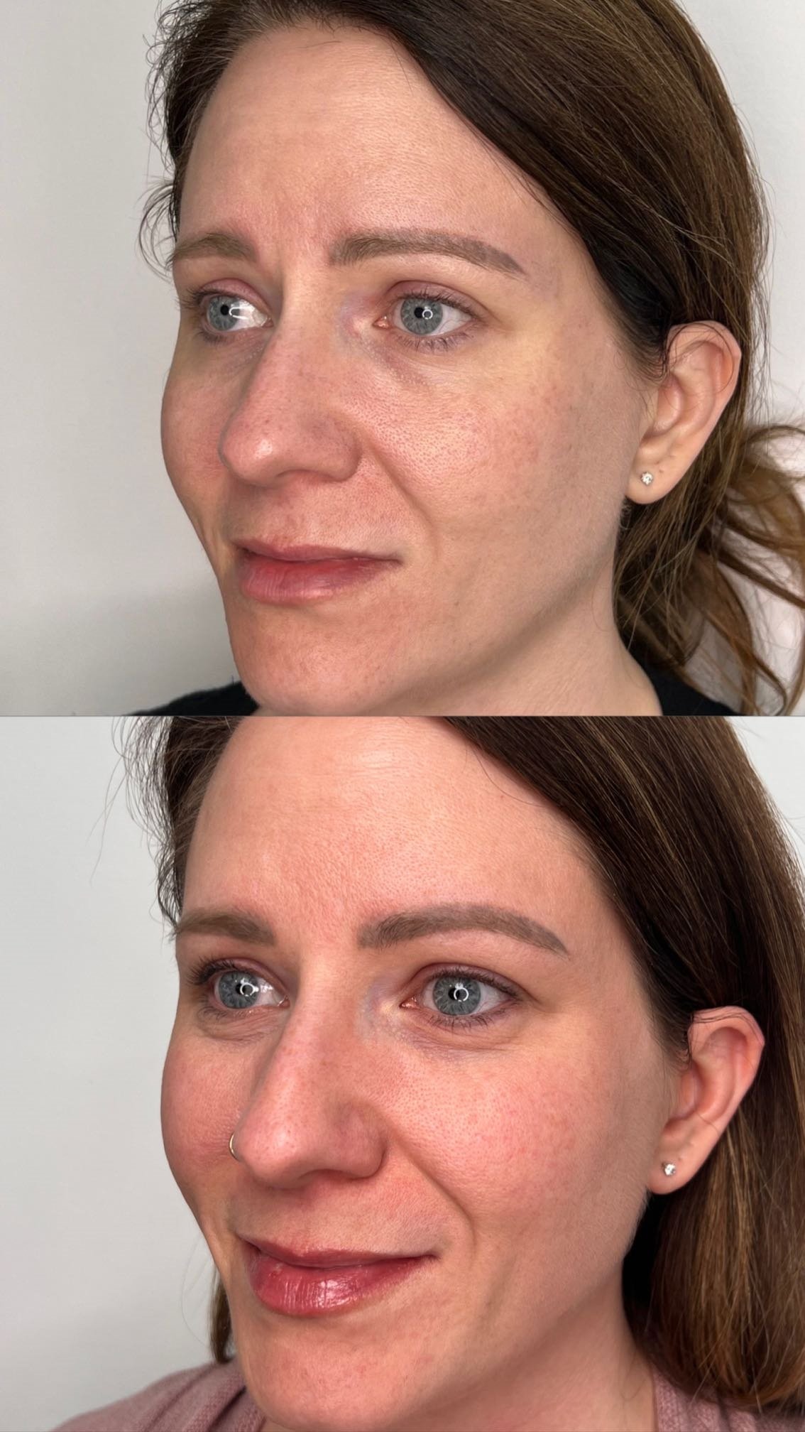 picosure-pro-pigmentation-results-12