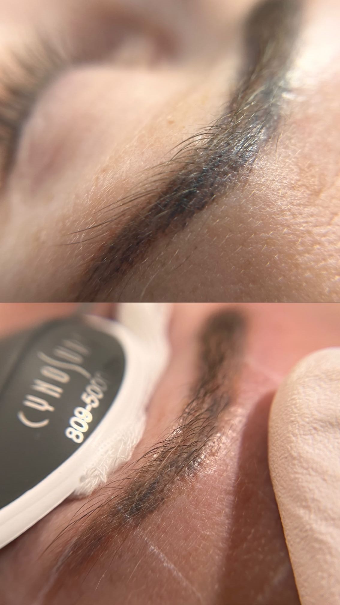 Skyns PicoSure Pro Eyebrow Tattoo Removal before and after 9.jpeg