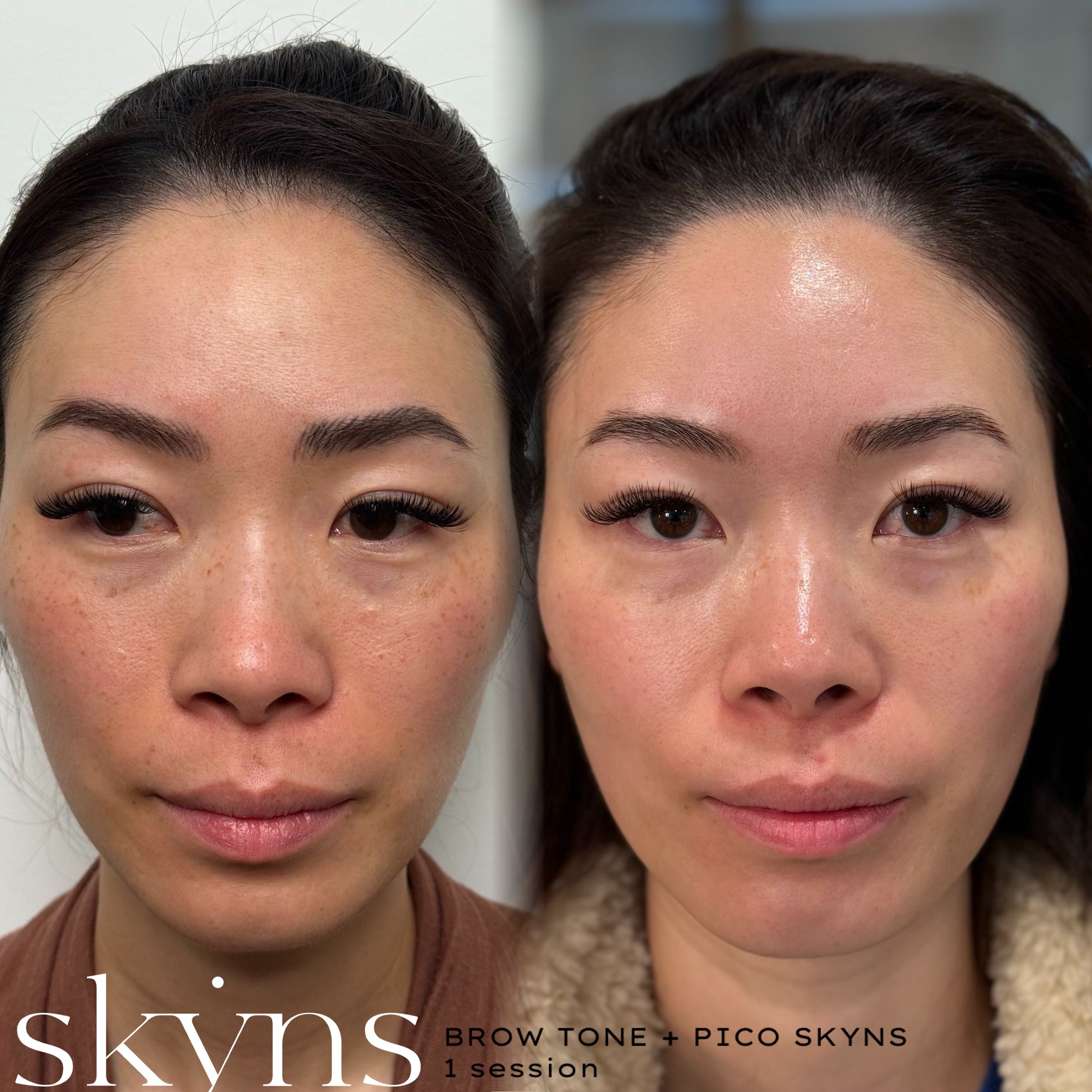 picosure-pro-pigmentation-results-01