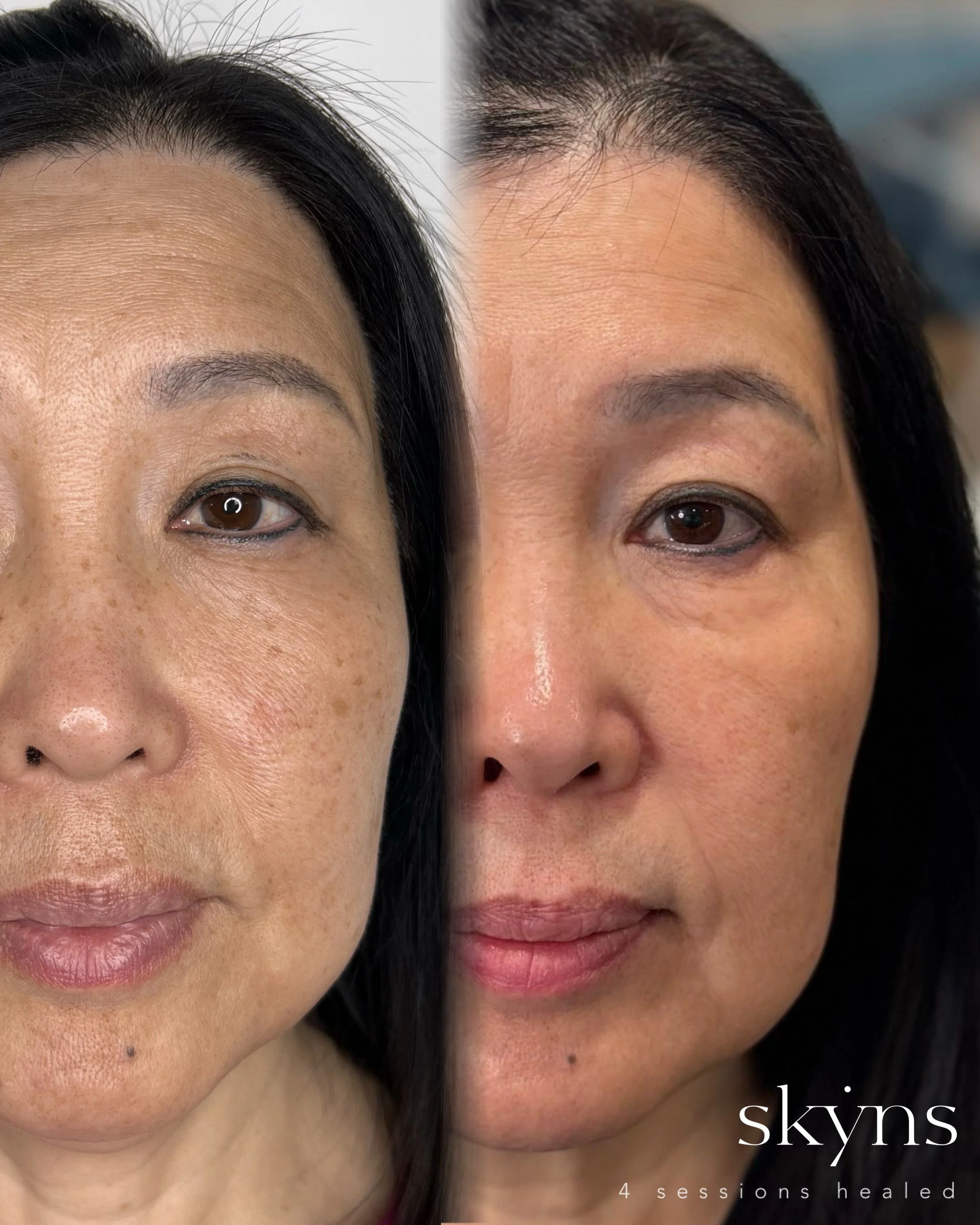 picosure-pro-pigmentation-results-02