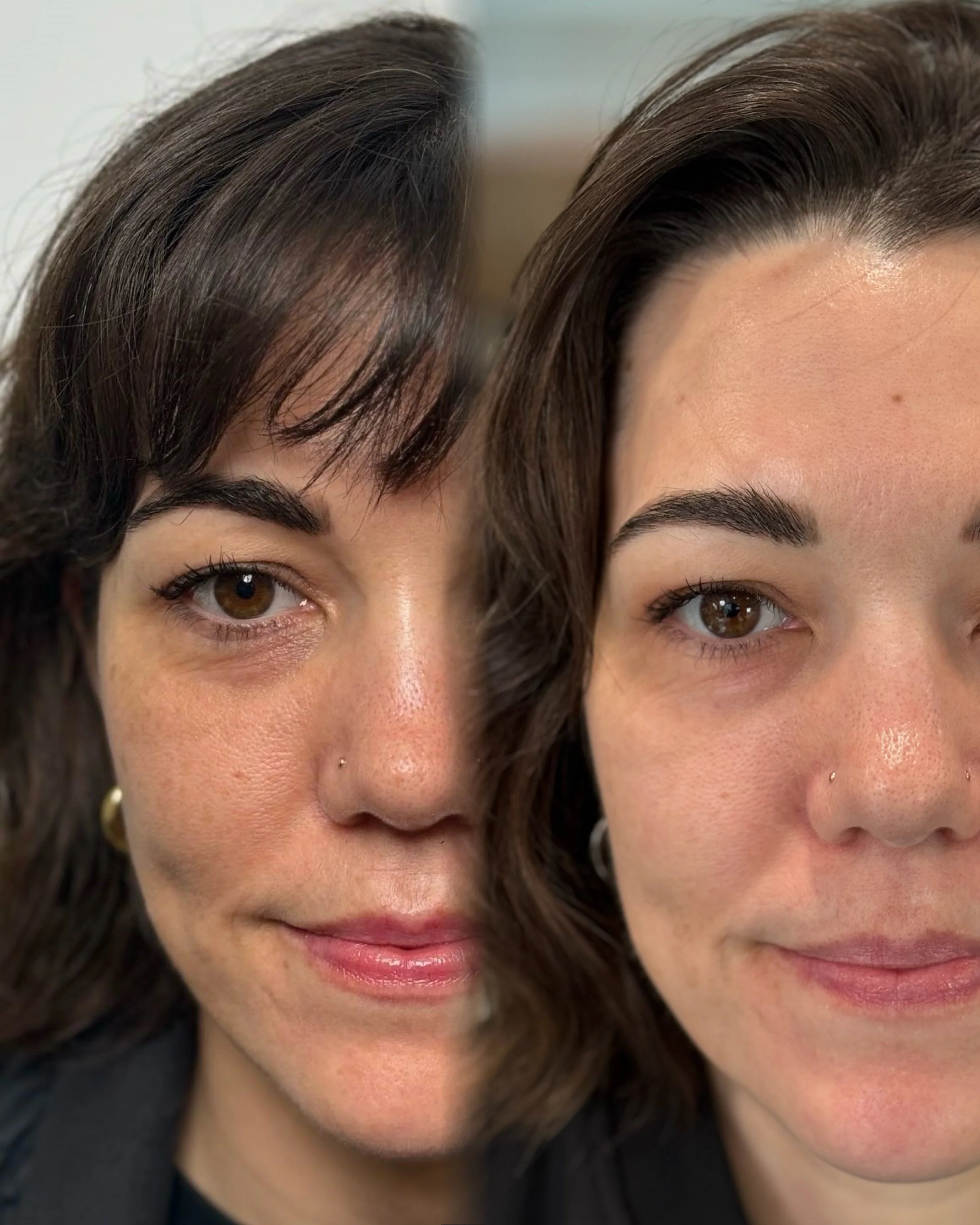 picosure-pro-pigmentation-results-03