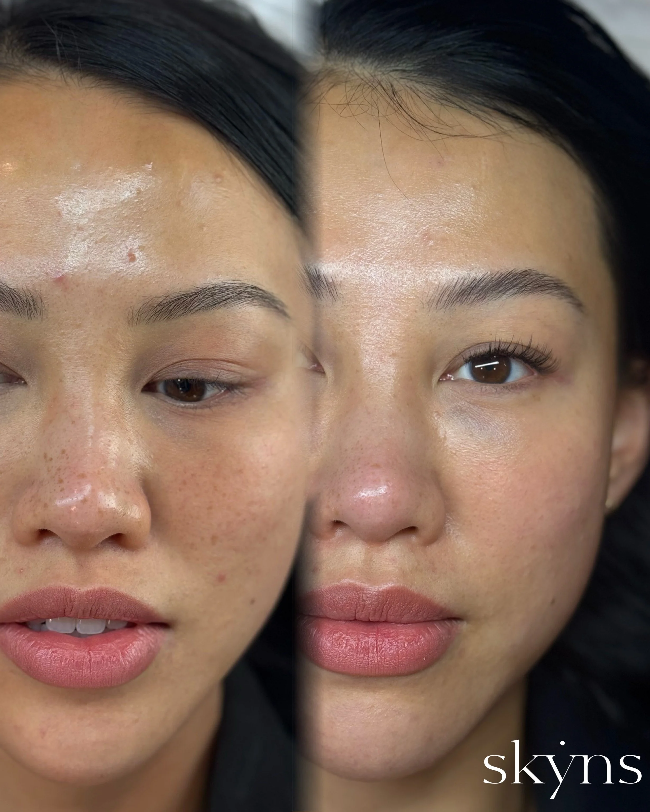 picosure-pro-pigmentation-results-04