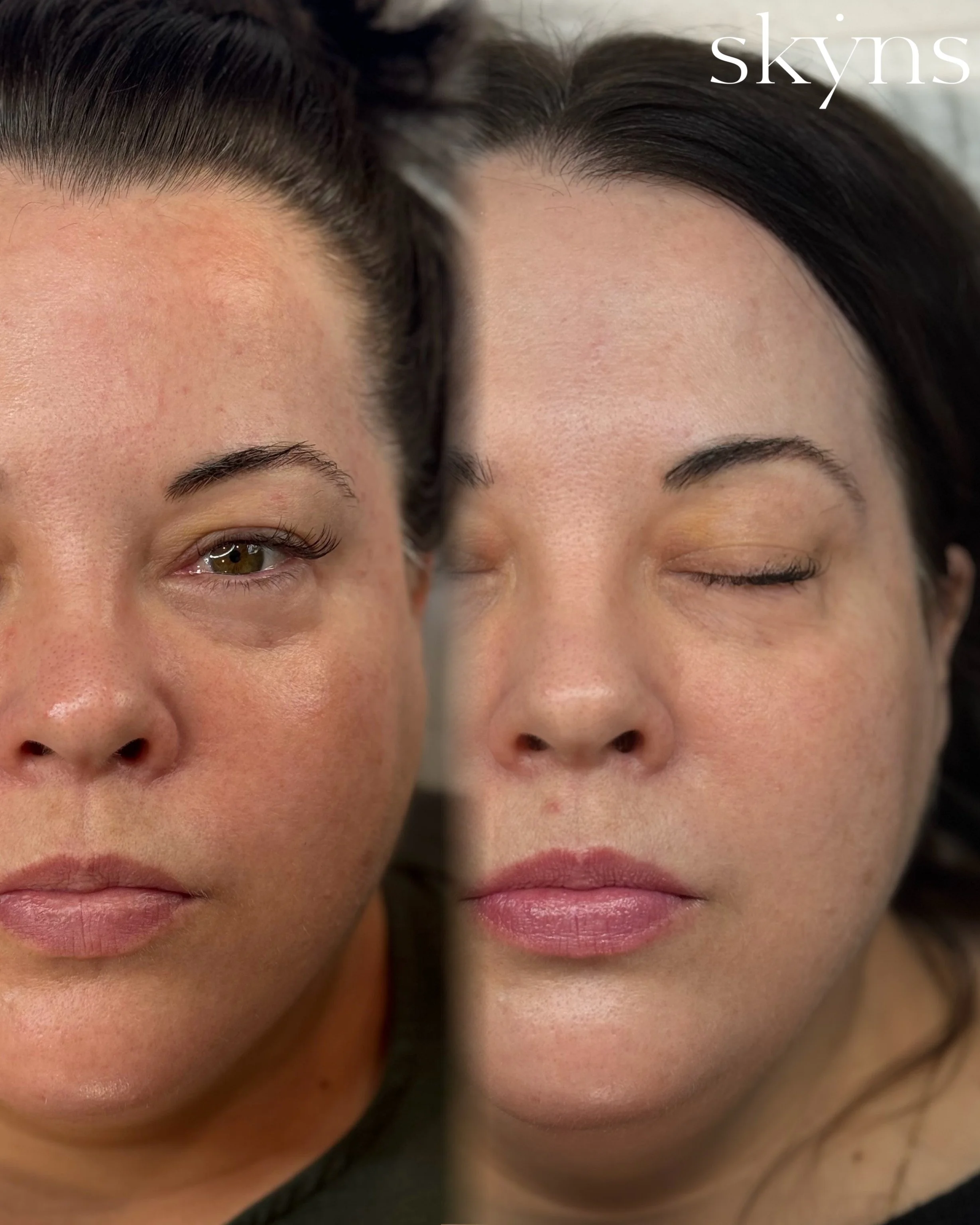 picosure-pro-pigmentation-results-05