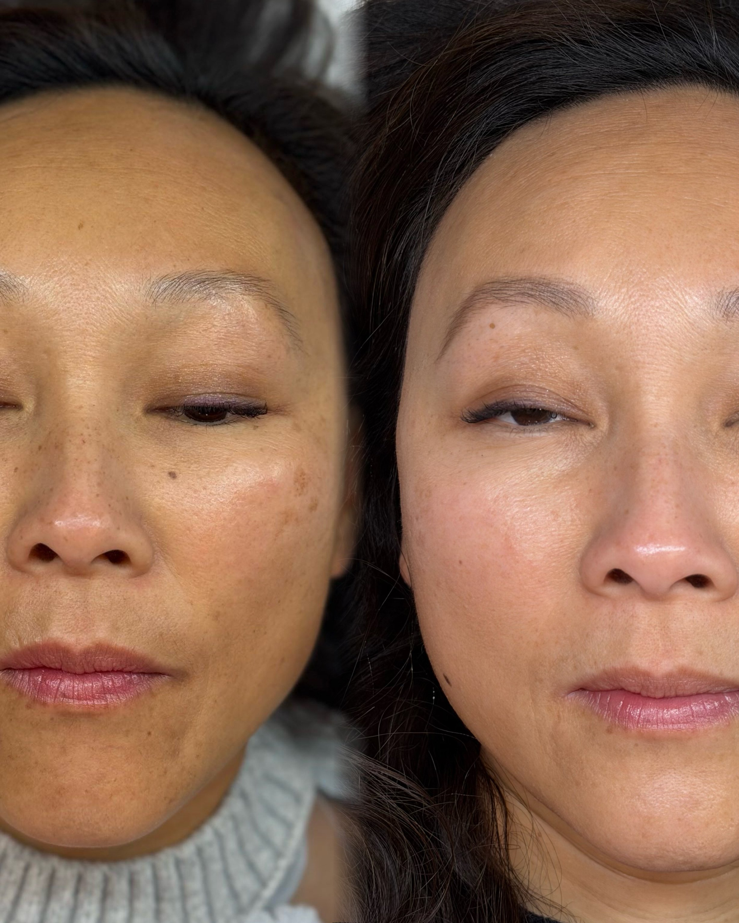 picosure-pro-pigmentation-results-06