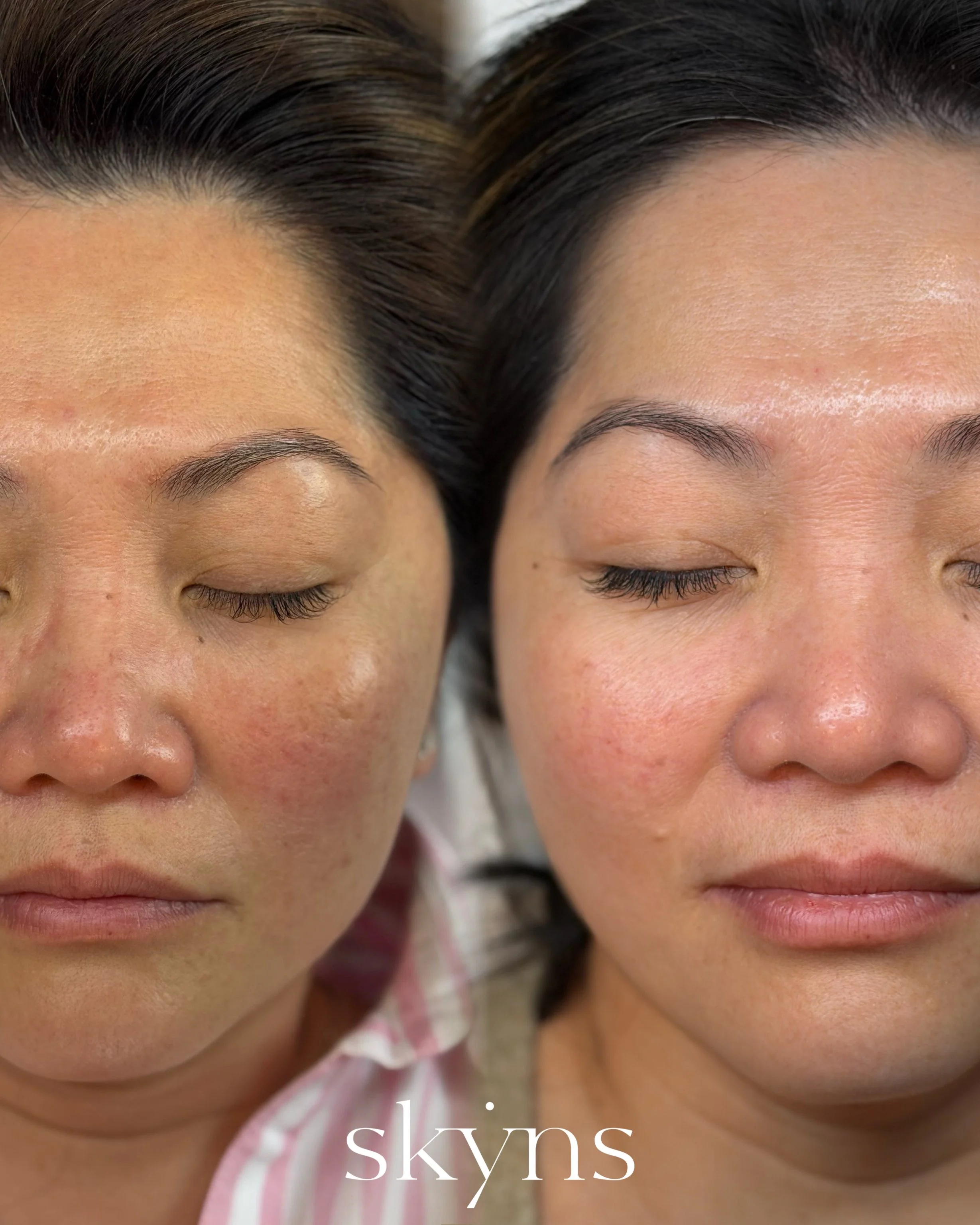 picosure-pro-pigmentation-results-07