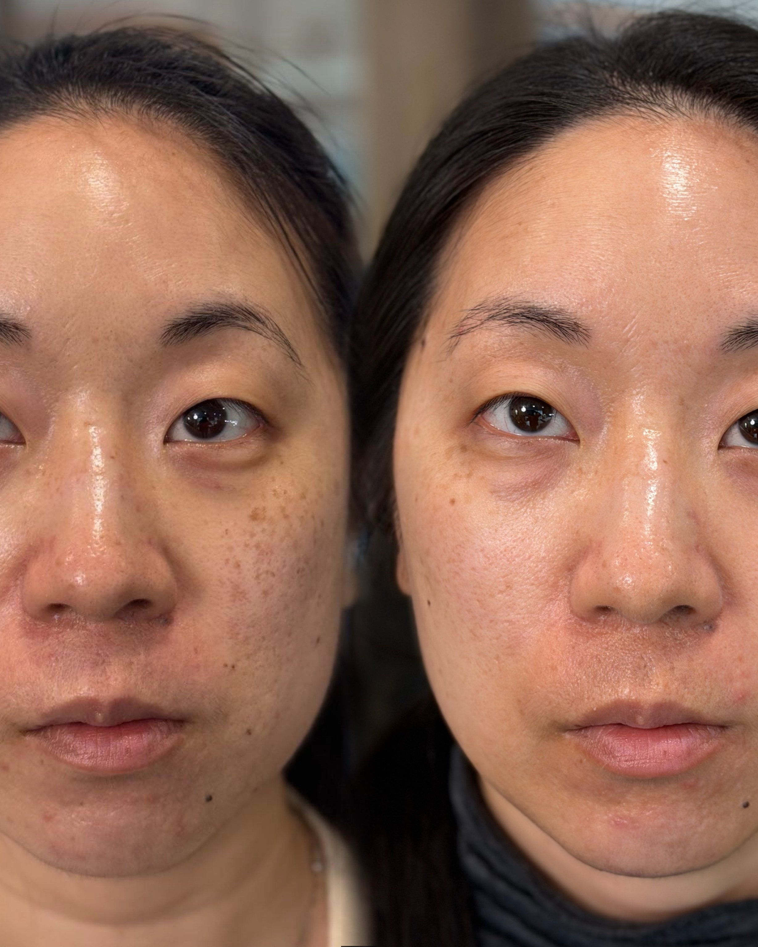 picosure-pro-pigmentation-results-08