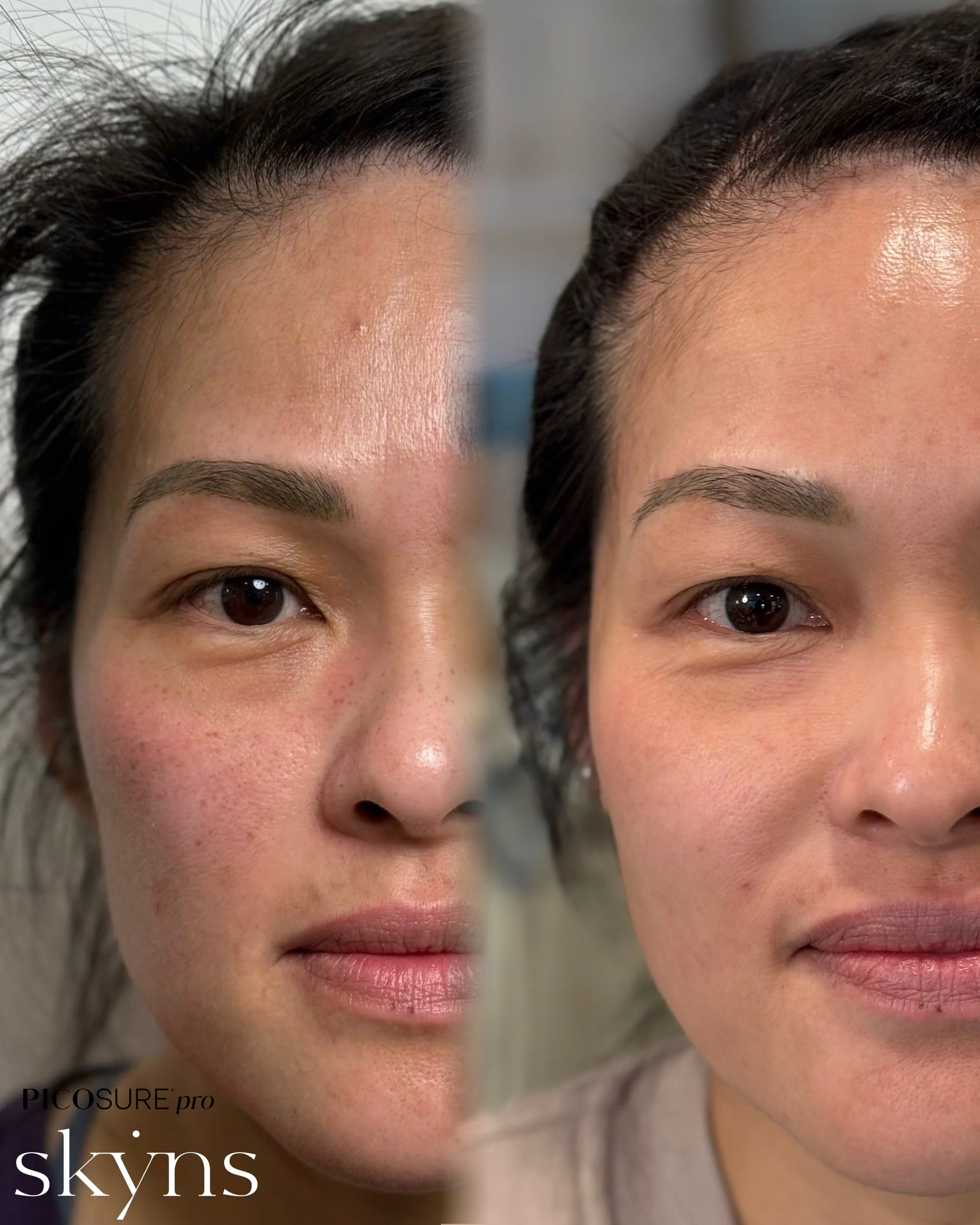 picosure-pro-pigmentation-results-09