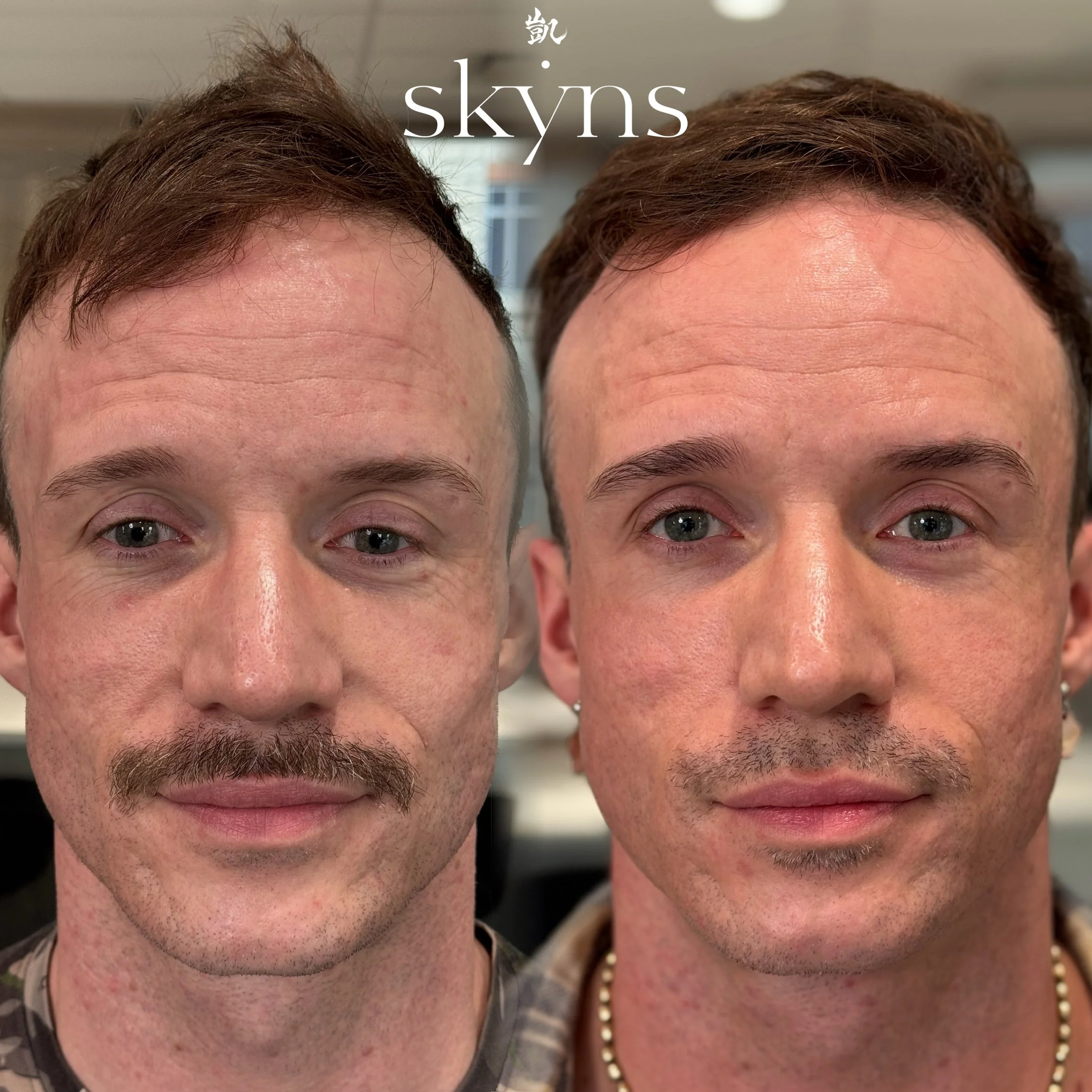 picosure-pro-pigmentation-results-10