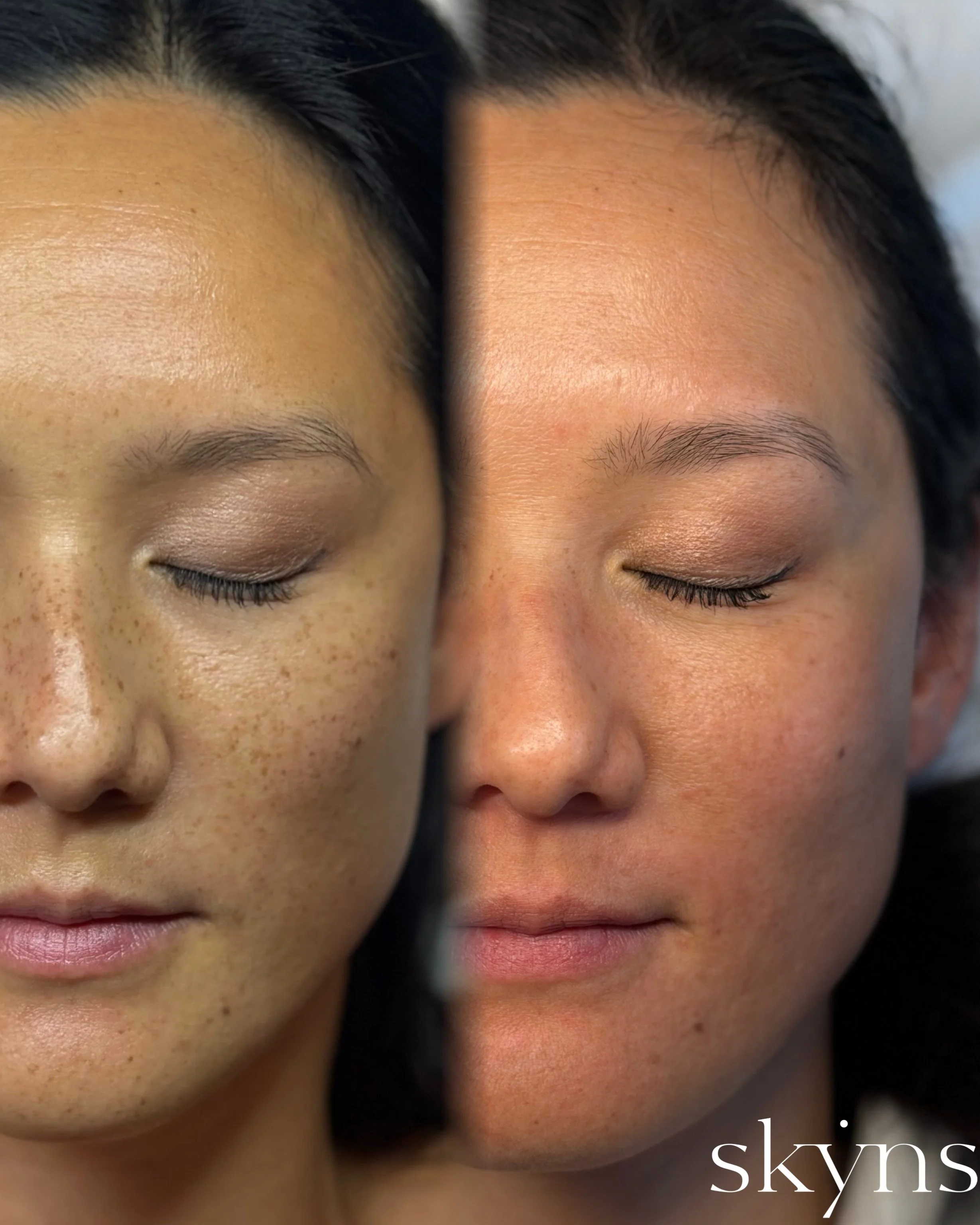 picosure-pro-pigmentation-results-11