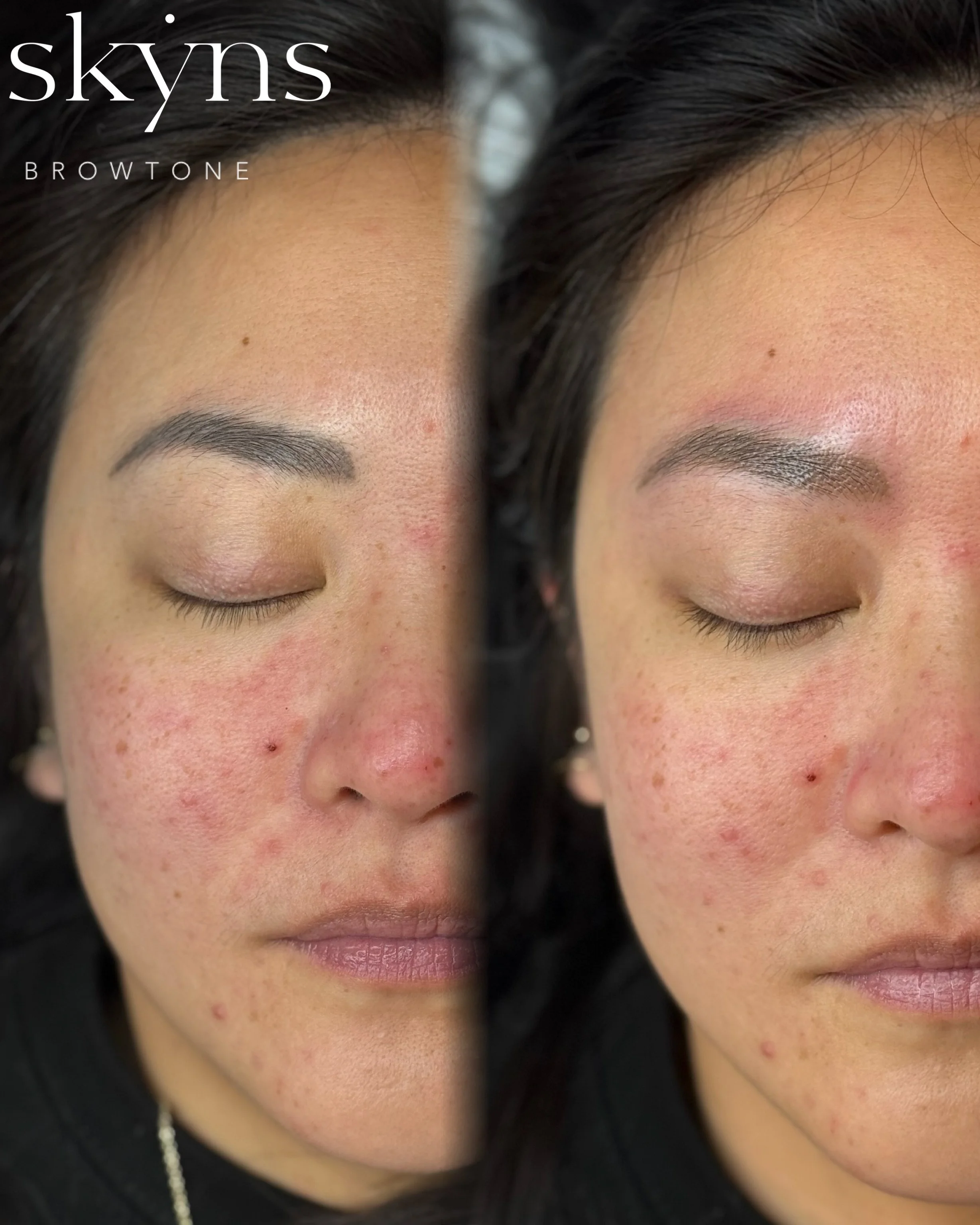picosure-pro-cosmetic-tattoo-removal-treatment-1