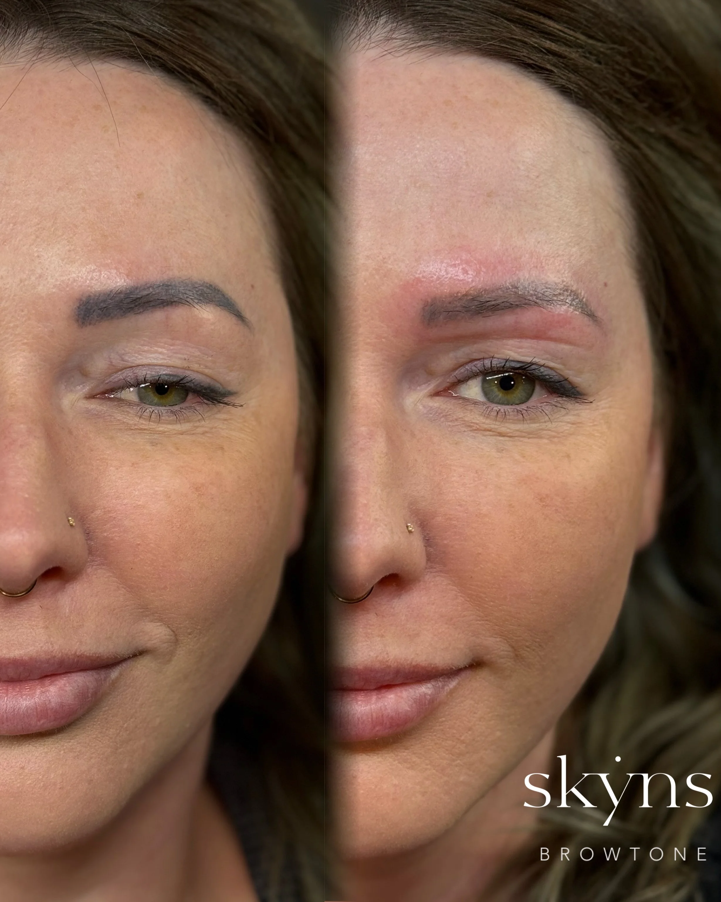 picosure-pro-cosmetic-tattoo-removal-treatment-2