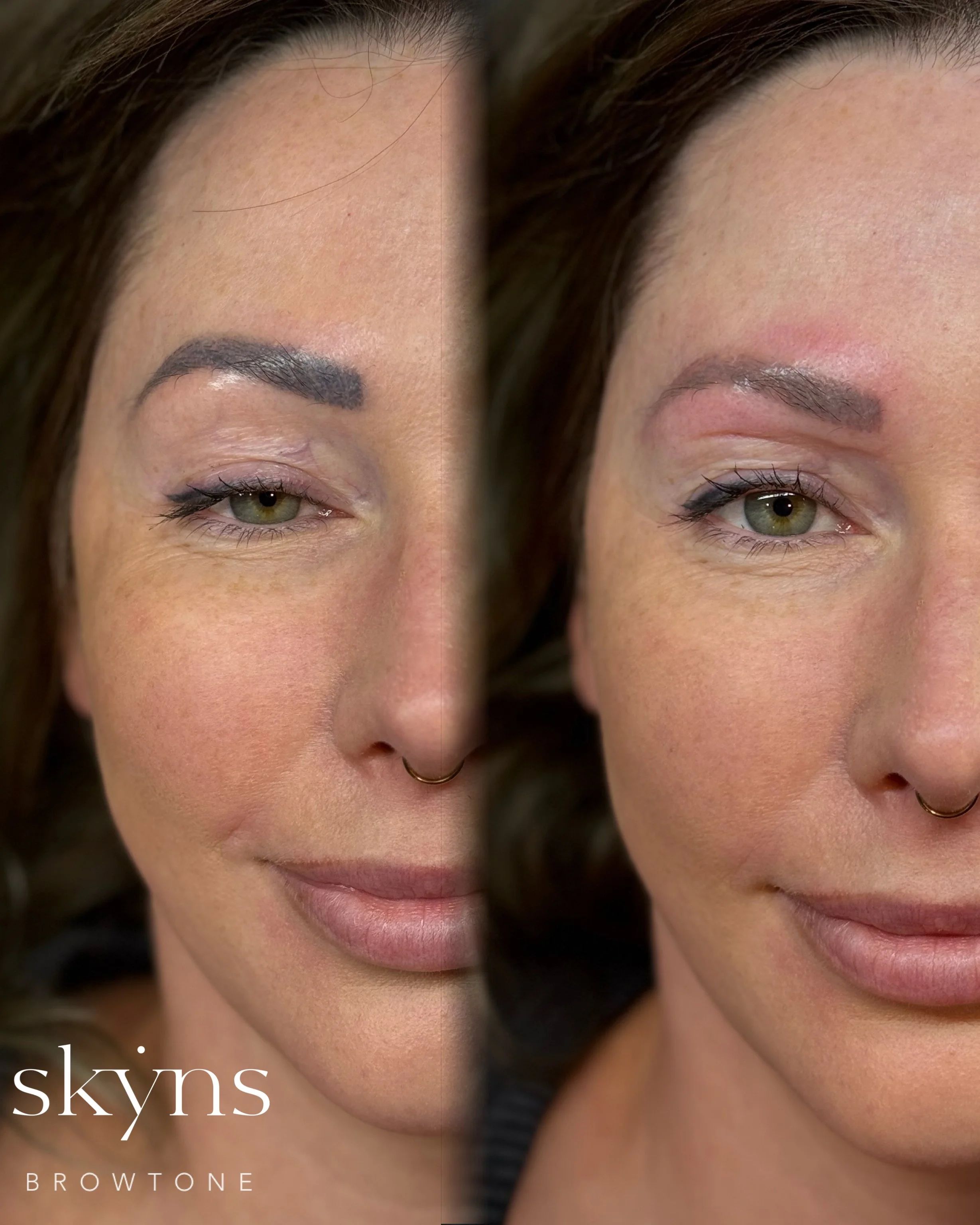 picosure-pro-cosmetic-tattoo-removal-treatment-3