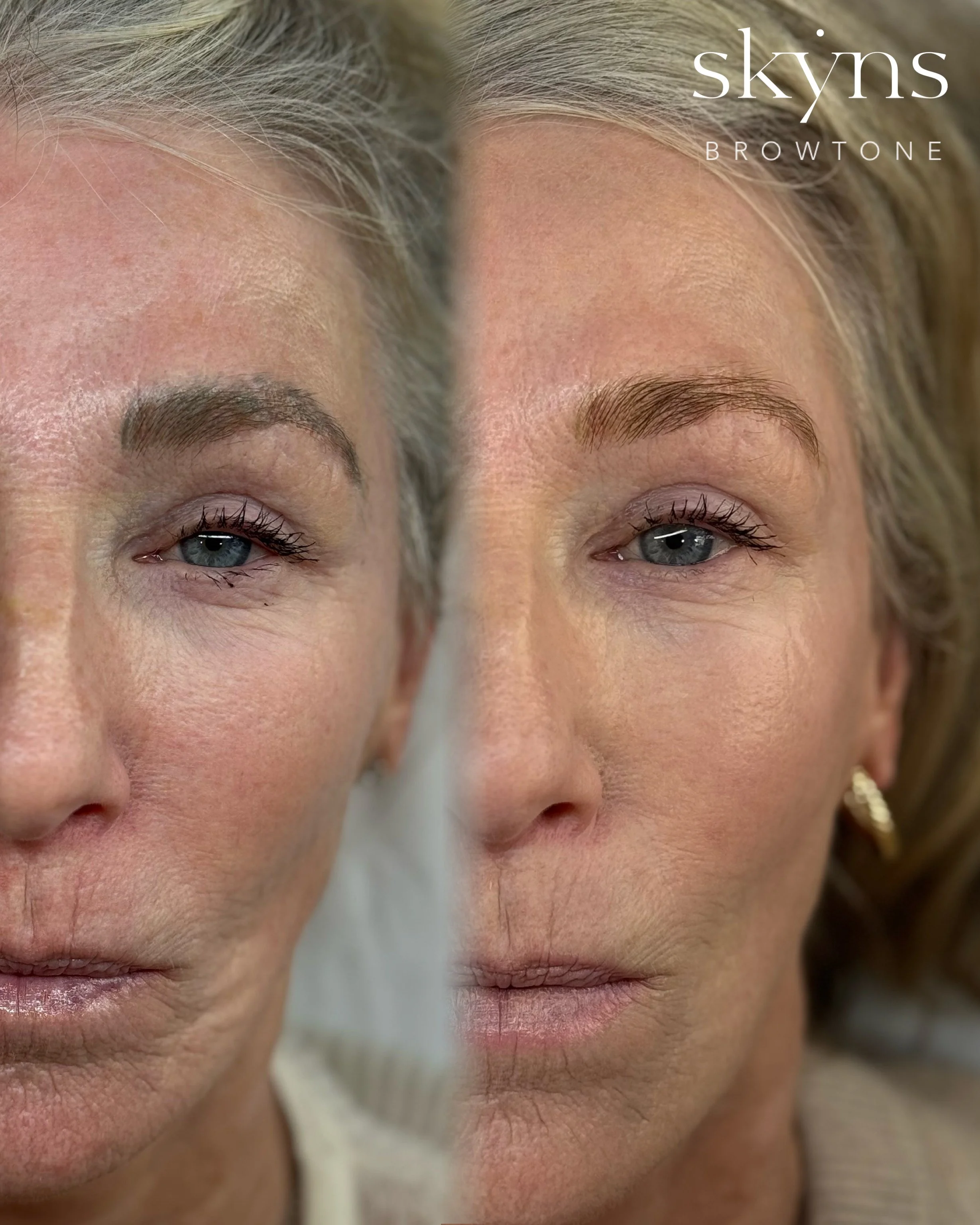 picosure-pro-cosmetic-tattoo-removal-treatment-4