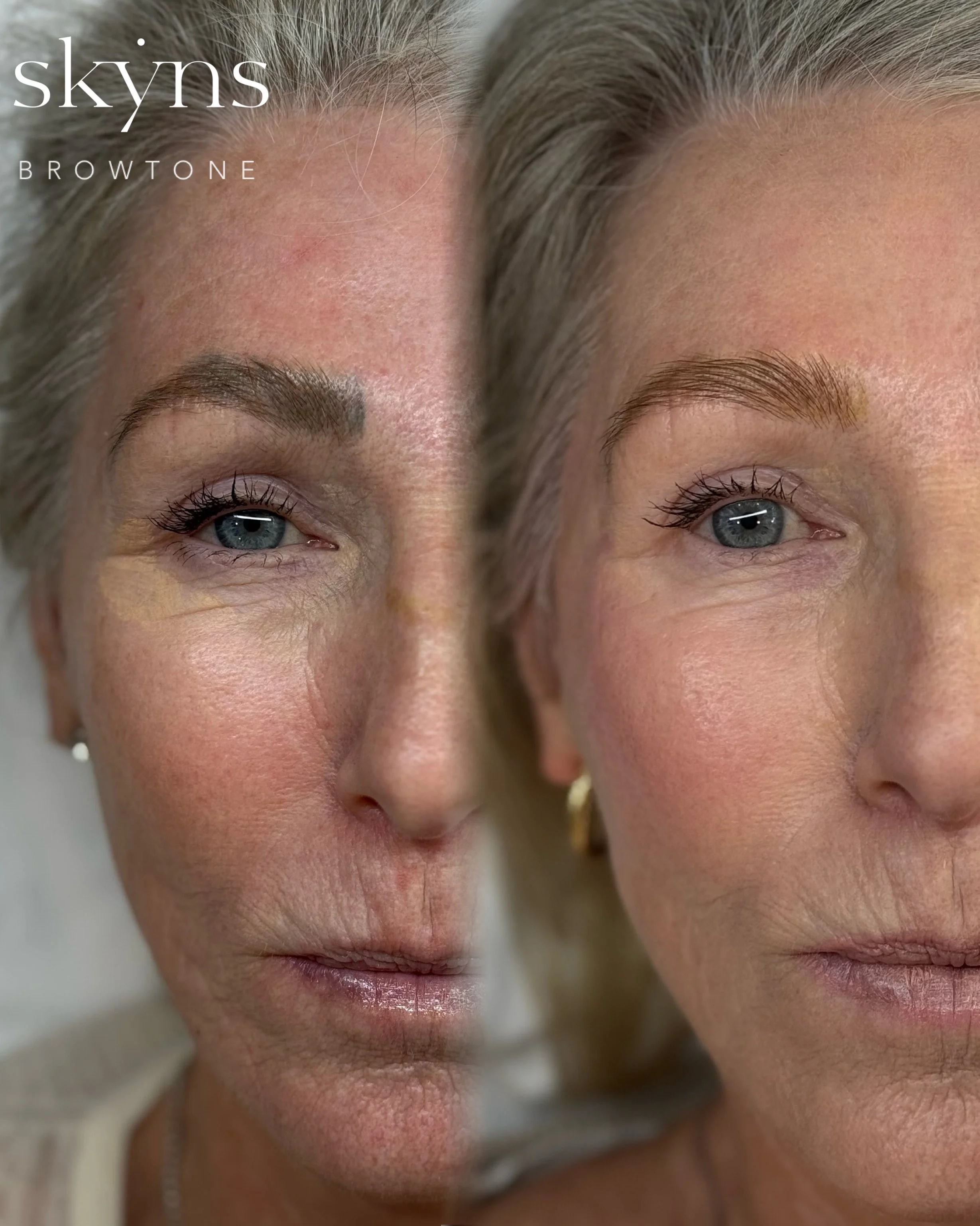 picosure-pro-cosmetic-tattoo-removal-treatment-5