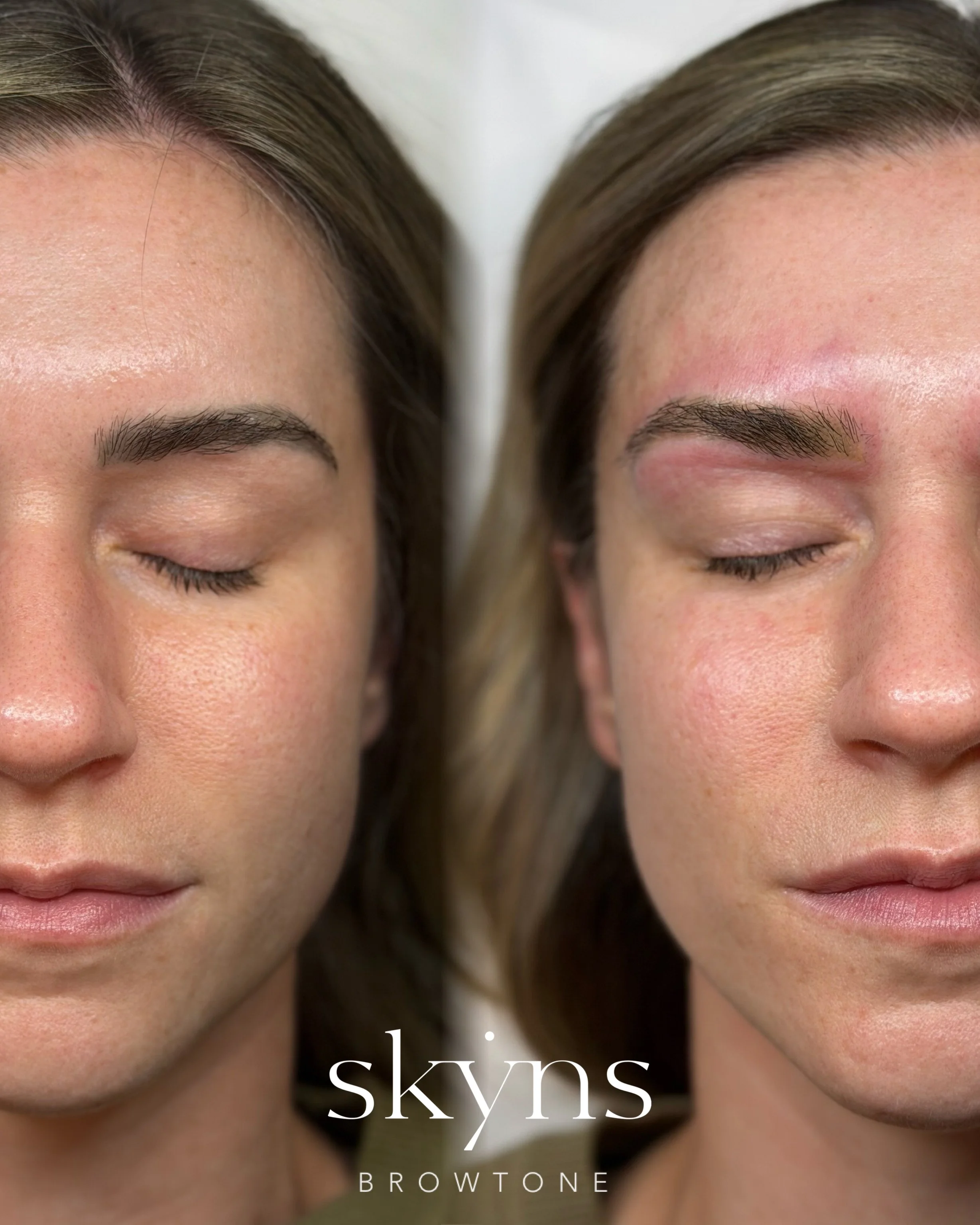 picosure-pro-cosmetic-tattoo-removal-treatment-7